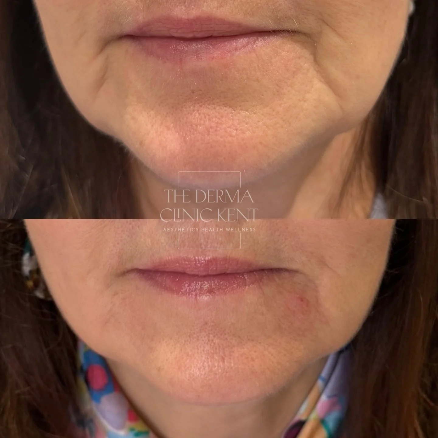 Have you noticed your lower face looking heavier or more downturned than it used to?

This patient came to us concerned about her marionette lines, the lines that run from the corners of the mouth down towards the chin - a very common ageing concern.