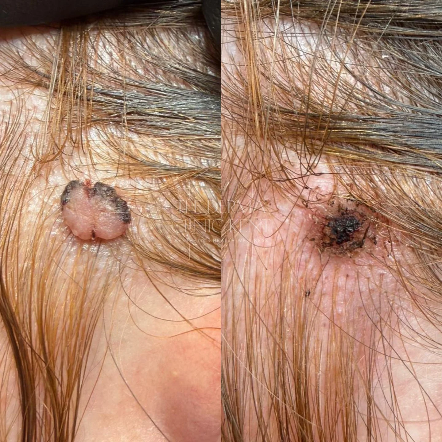 This patient came to us with a raised lesion at the hairline that had been there for a while and was ready to have it gone. We were able to remove it precisely and effectively in a single session, with no need for surgery or stitches.

The right imag