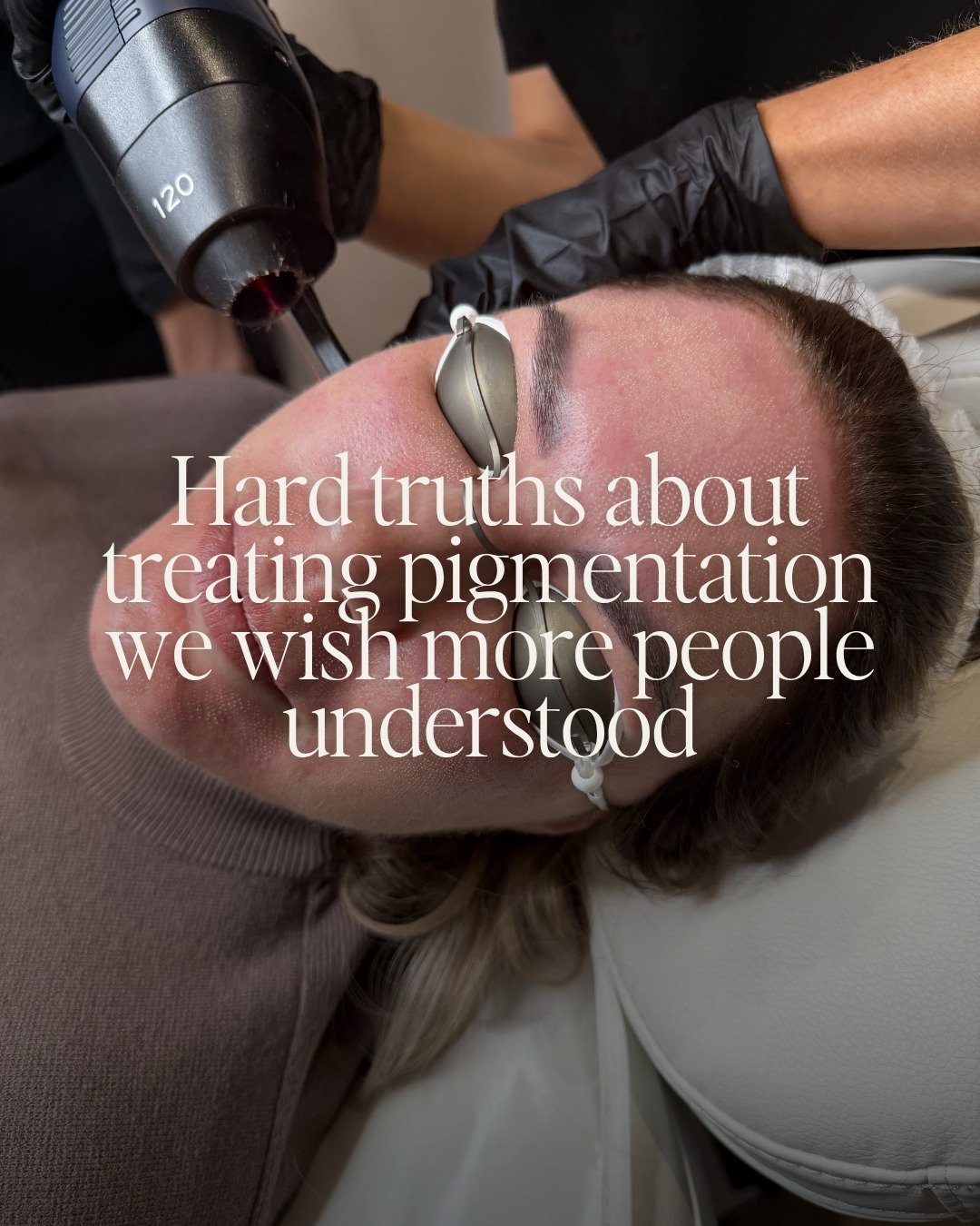 Pigmentation is one of the most common concerns we treat, and also one of the most misunderstood.

Most people come to us having already tried something that hasn't worked, whether that's a product, a treatment, or both.

More often than not, it's no