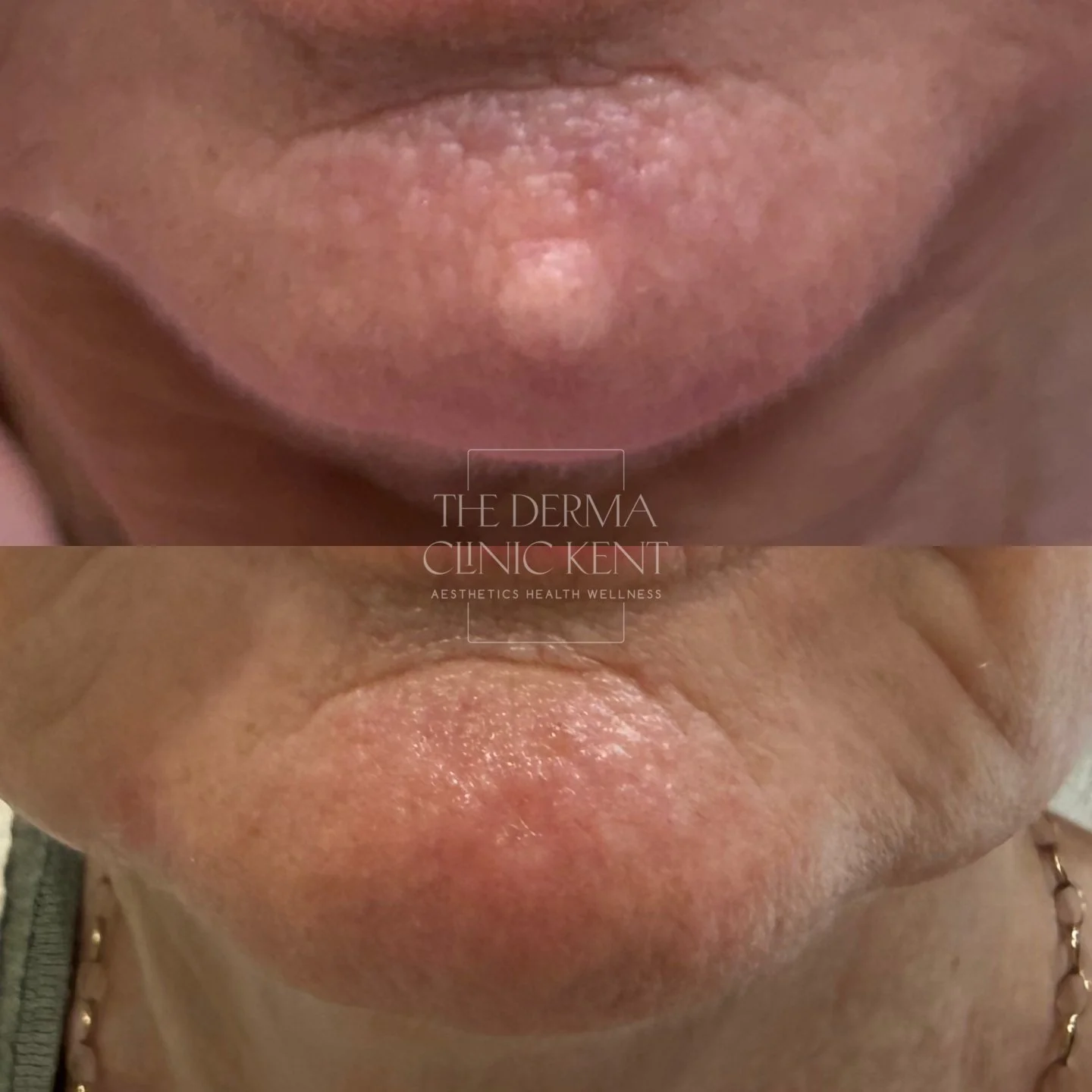 Small treatment, big difference in how you feel about your skin.

This patient came to us with a lesion on her chin that had been bothering her for a long time.

Not for any medical reason, just one of those things you become increasingly aware of an