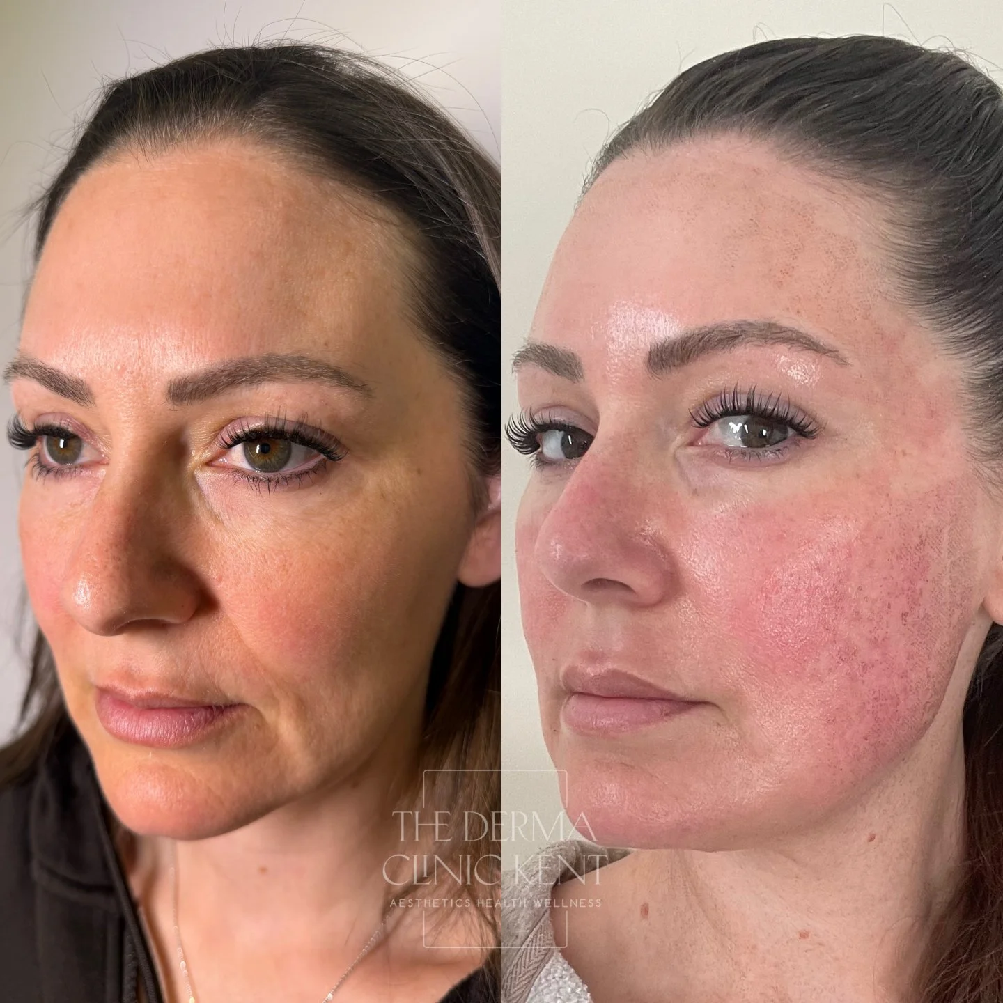 eCO2 results in progress 💪🏼✨️

The image on the right is taken immediately after her first eCO2 laser treatment. The redness, the heat, the intensity, that's the skin responding exactly as it should. It can feel like a lot in the moment, but it's a