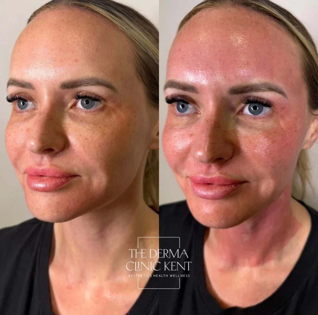 Meet our newest treatment, the Lutronic eCO2 laser. This is what the skin looks like immediately after a session.

We're so excited to be introducing this to our treatment menu, and we wanted to share an honest, real result straight from the treatmen
