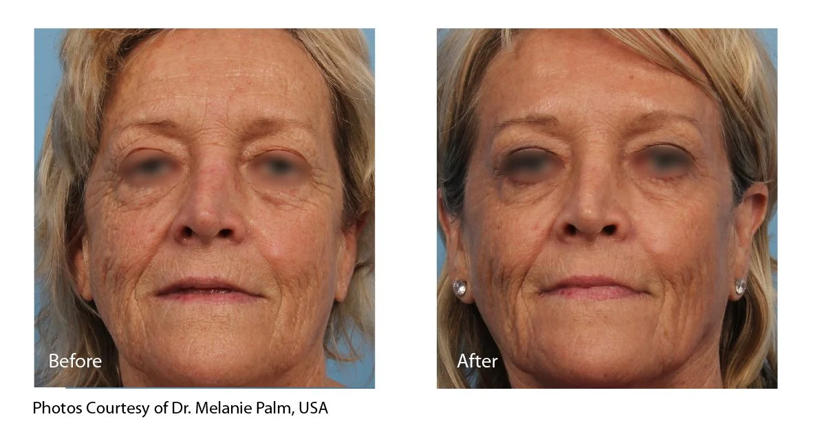 Side-by-side comparison of a woman's face before and after cosmetic treatment, showing reduction in wrinkles and signs of aging. Using eCO2. Available in Canterbury, Kent.