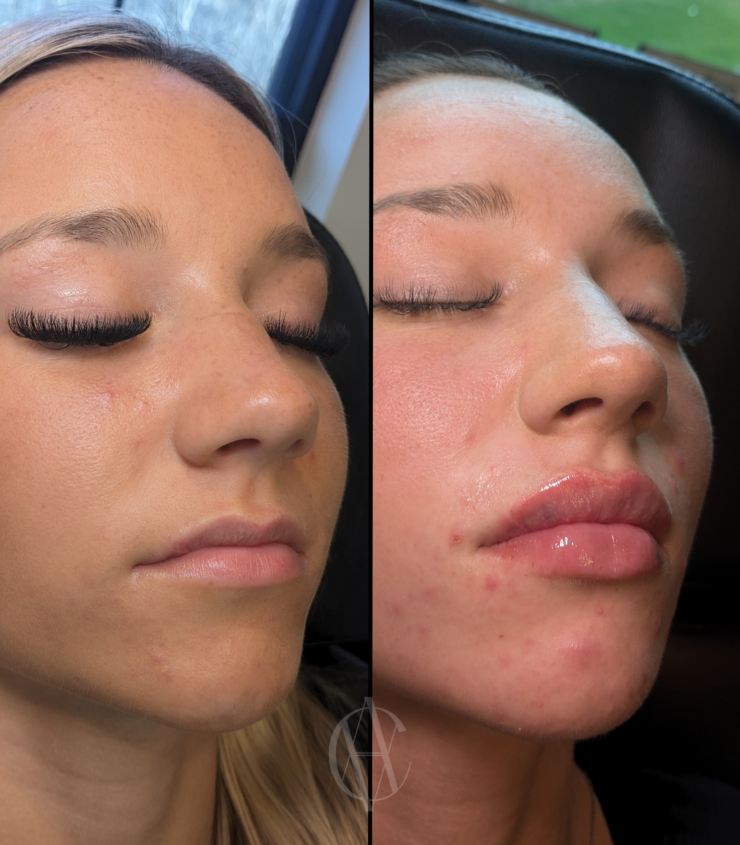 lip-filler-before-and-after-injected-at-a-class-aesthtetics-med-spa-.PNG