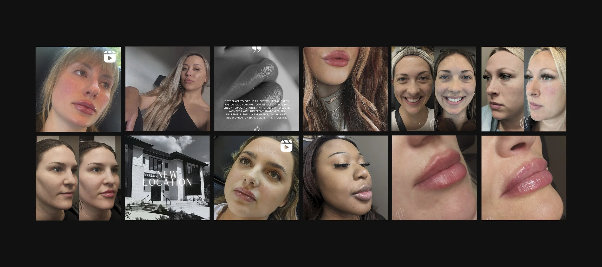 Lip Flip Botox Milwaukee — ⬦ AClass Aesthetics