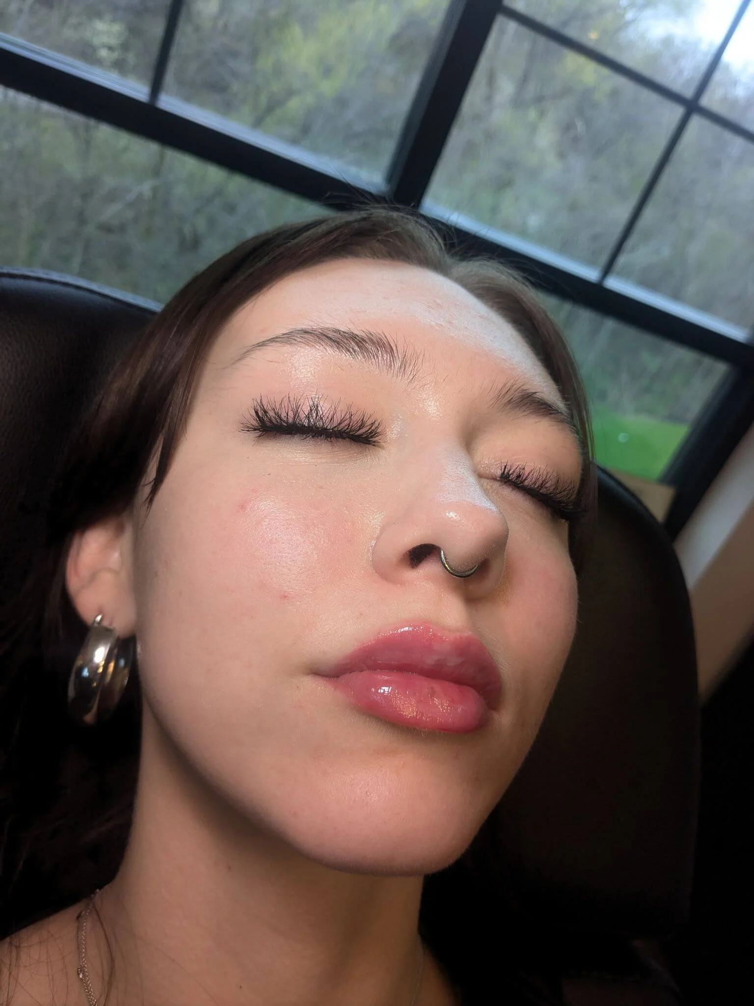 Lip filler results immediately after treatment showing improved symmetry, shape and plumpness 