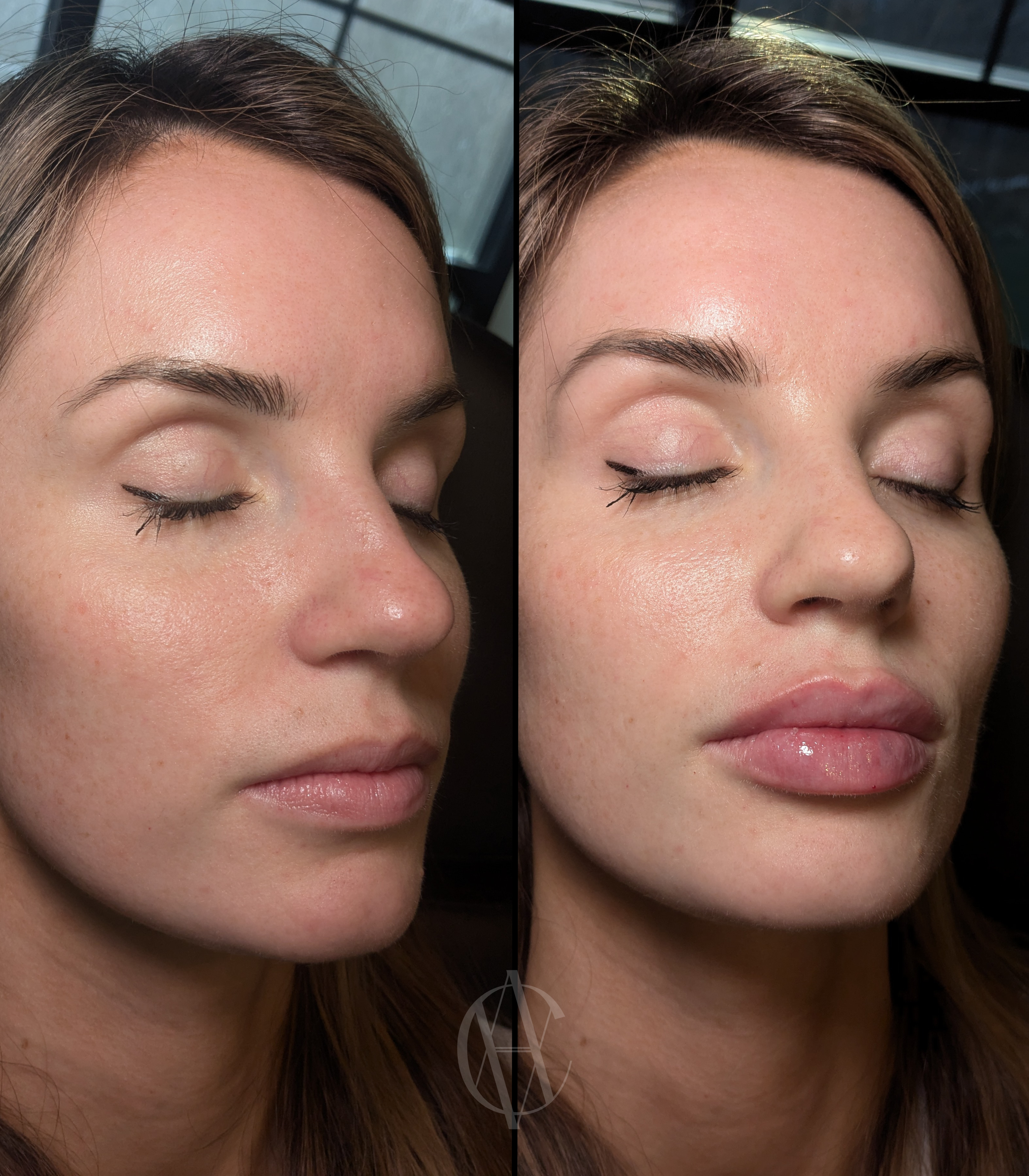 lip-fillers-before-and-after-injected-at-a-class-aesthetics-med-spa-in-wisconsin-.PNG
