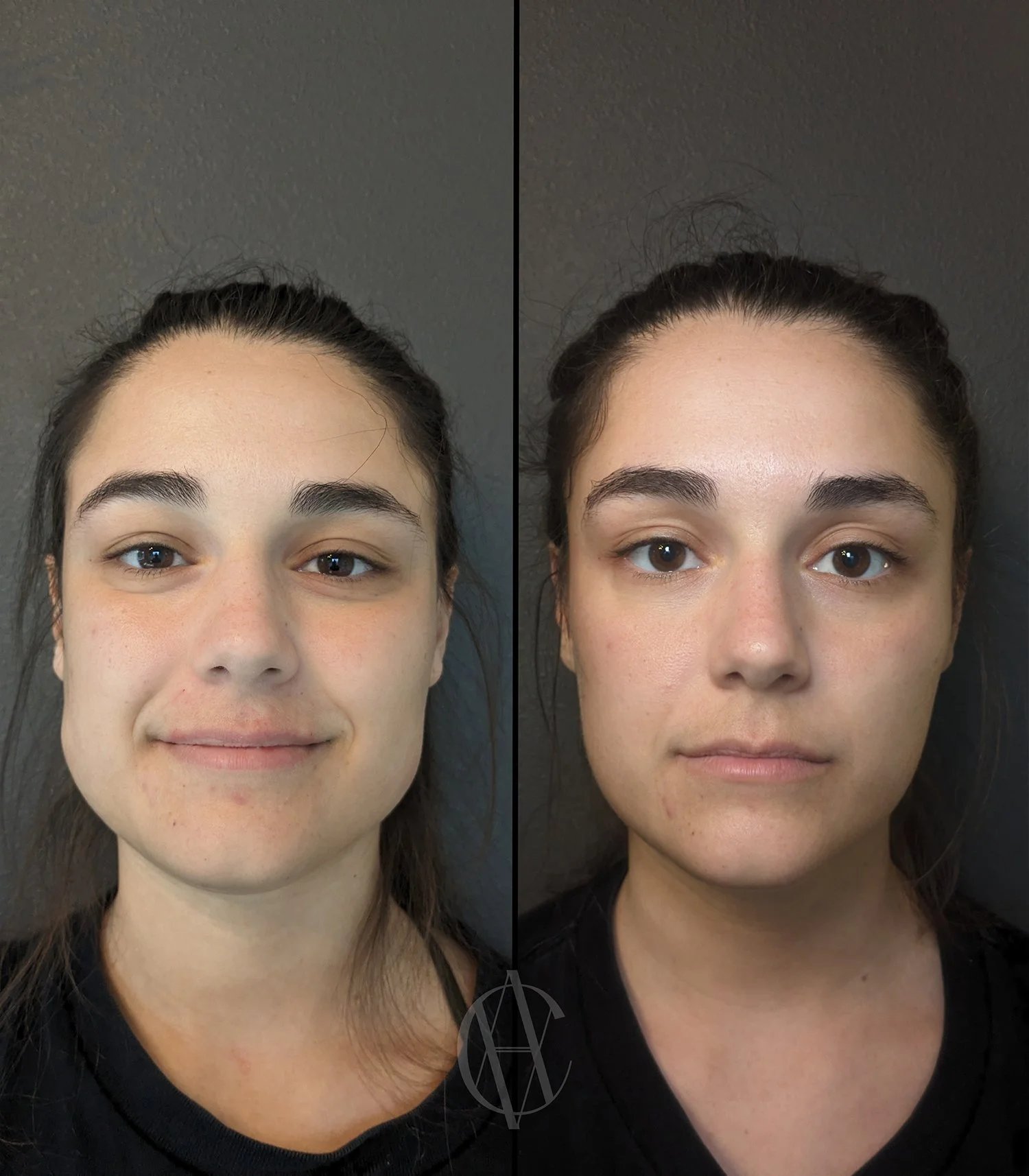 Masseter Botox in Milwaukee — ⬦ AClass Aesthetics