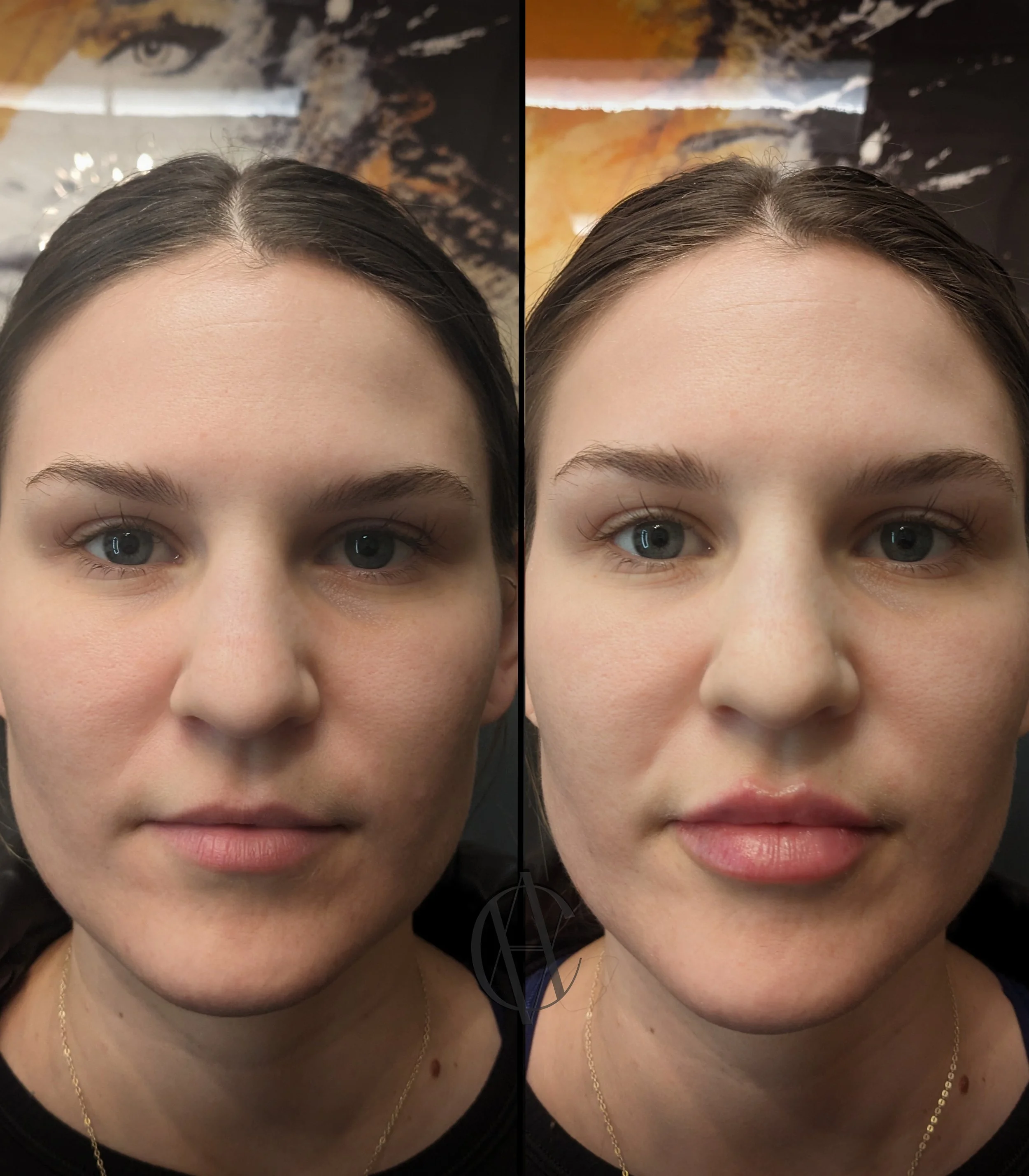 lip fillers before and after injections at A-Class Aesthetics with 1 ml lip filler