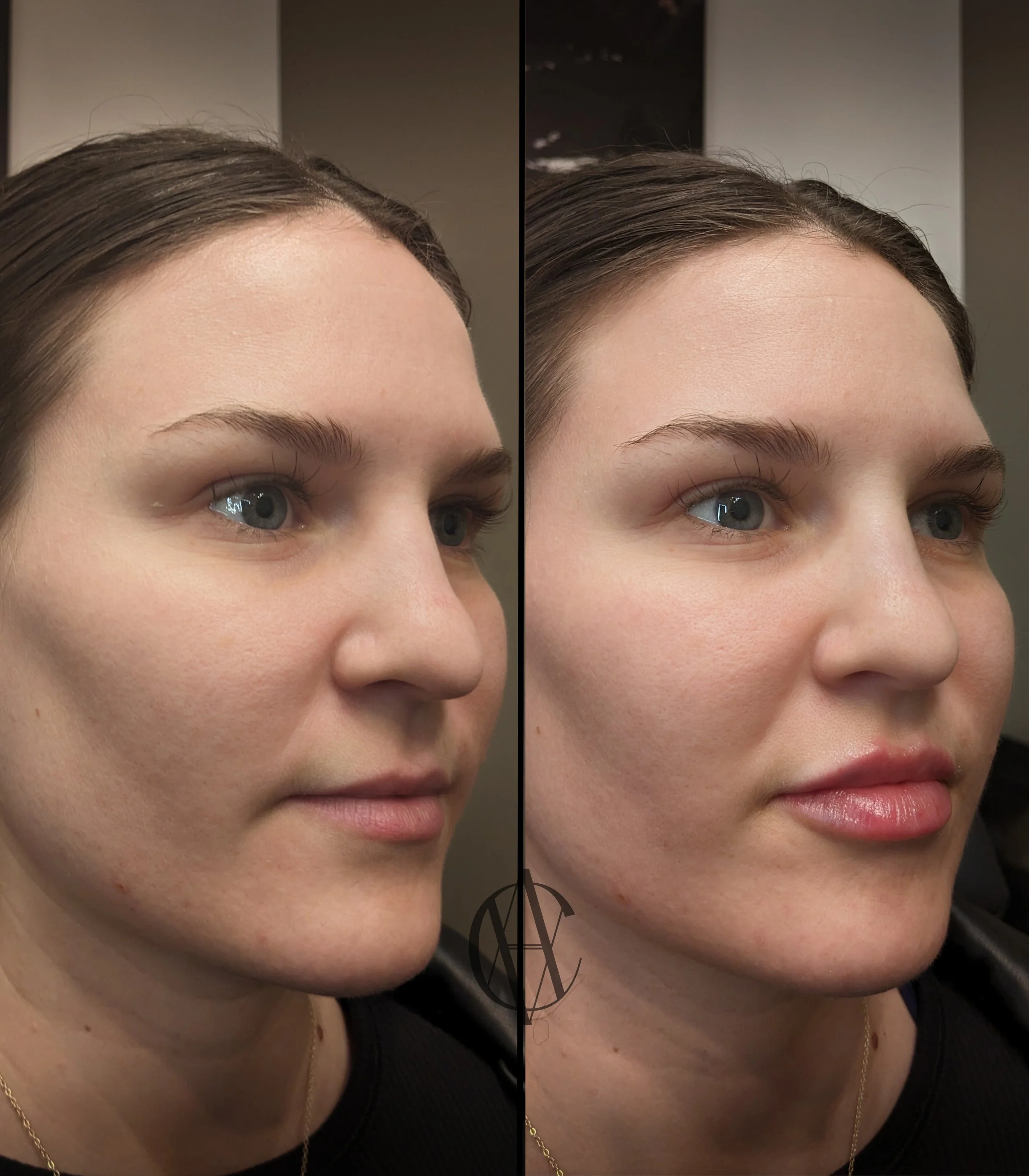 The best med spa in Milwaukee performing lip injections
