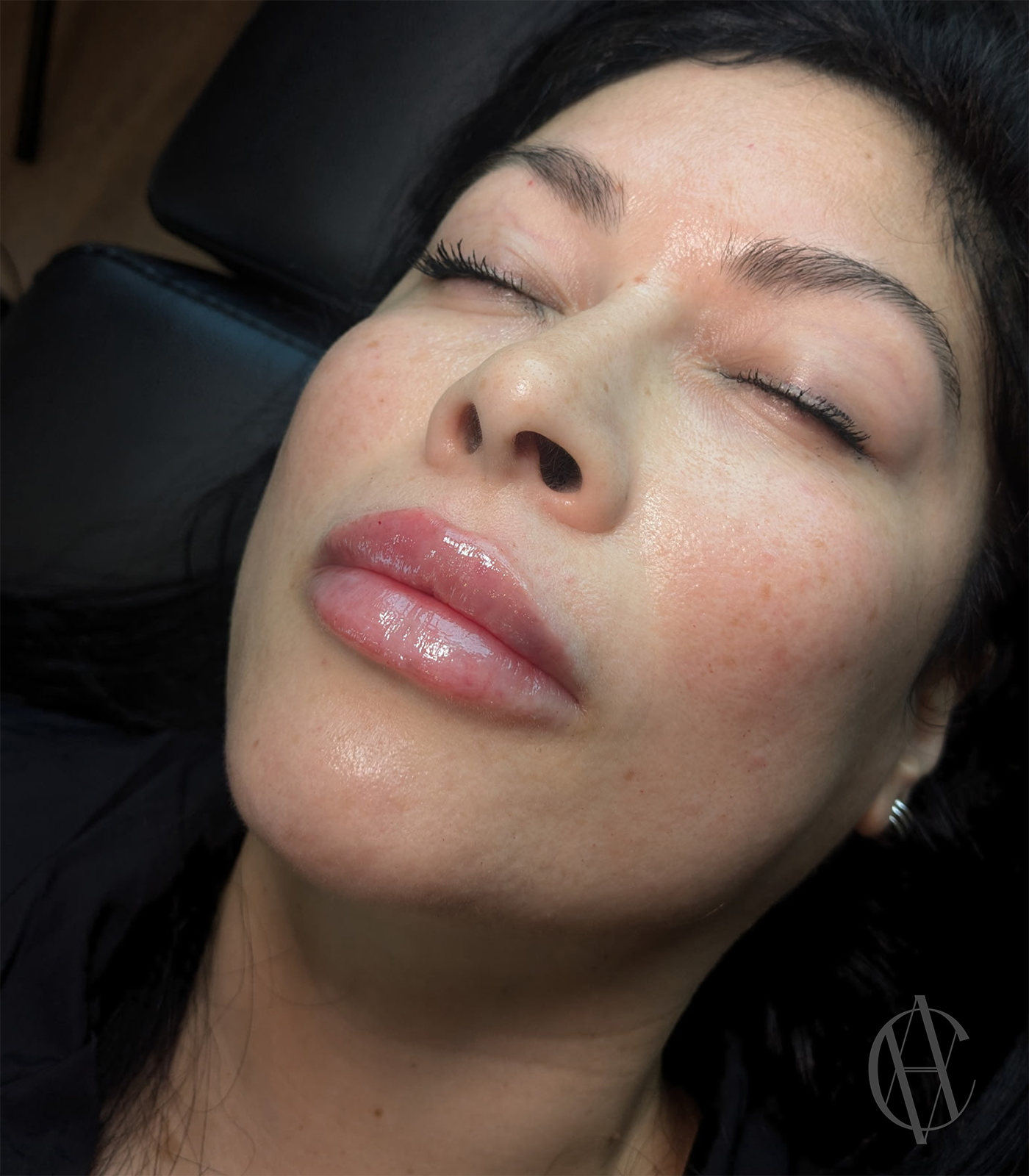 lip-injections-at-a-class-aesthetics-med-spa-in-wisconsin-fuller-naturally-shaped-lips.PNG