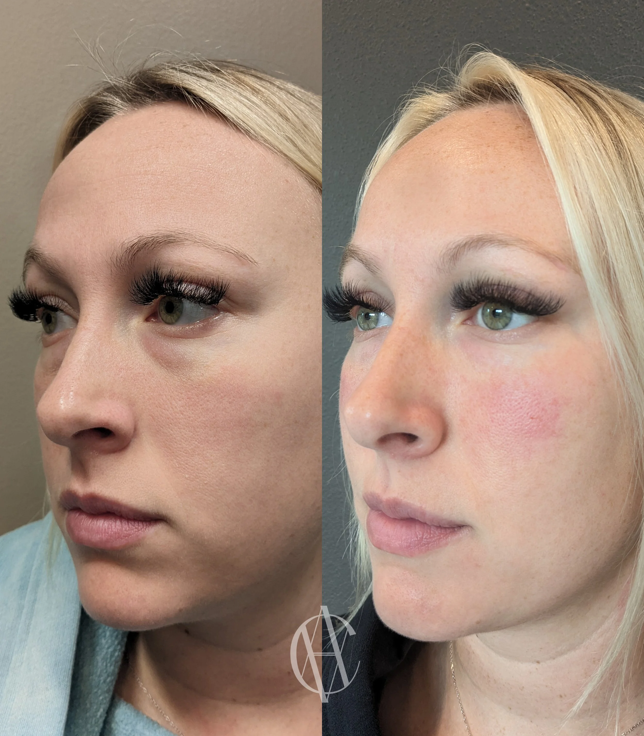 Med Spa in Milwaukee, A-Class Aesthetics Under Eye Filler Treatment