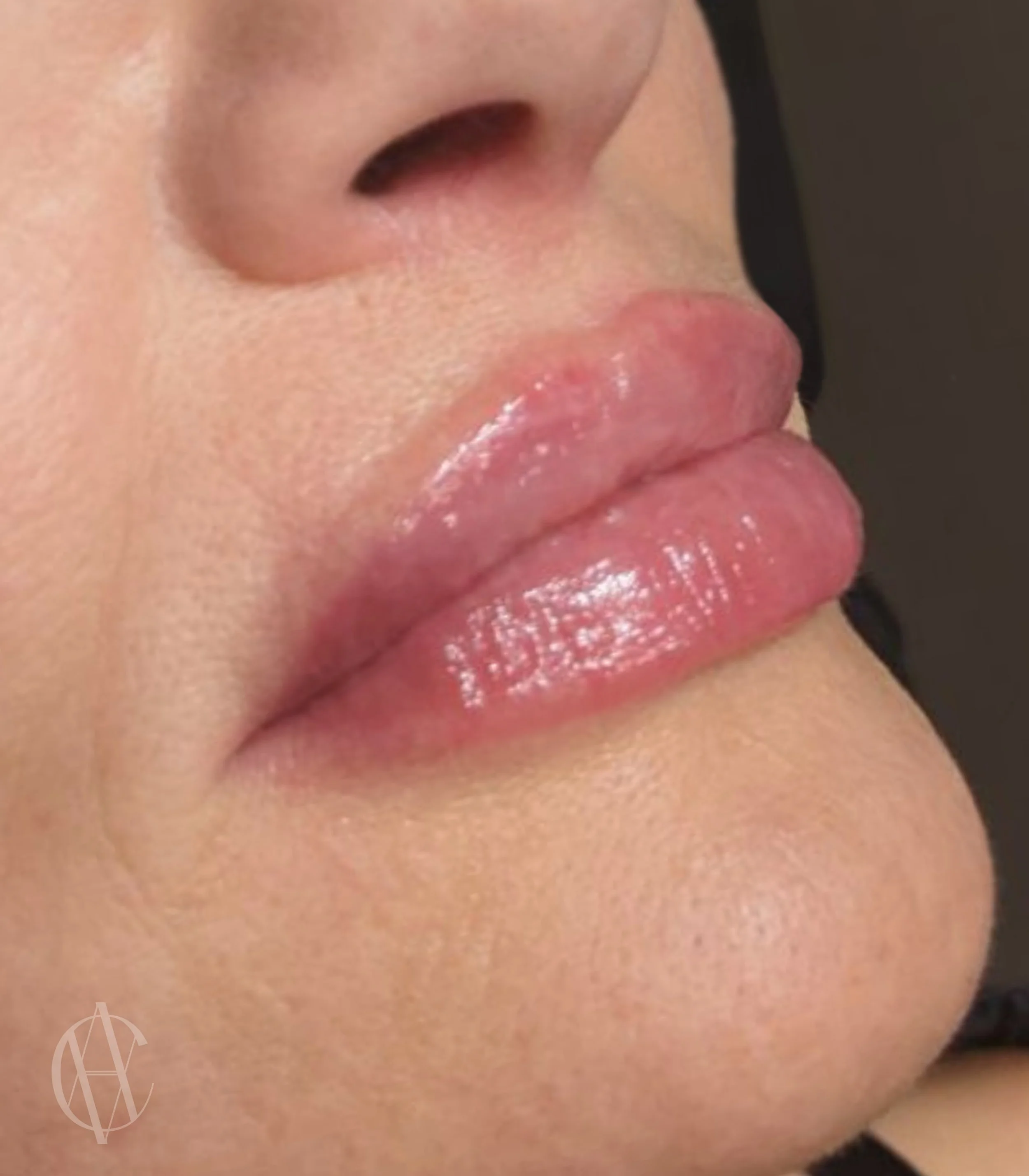 a women with a perfect lip shape after lip fillers performed by A Class Aesthetics