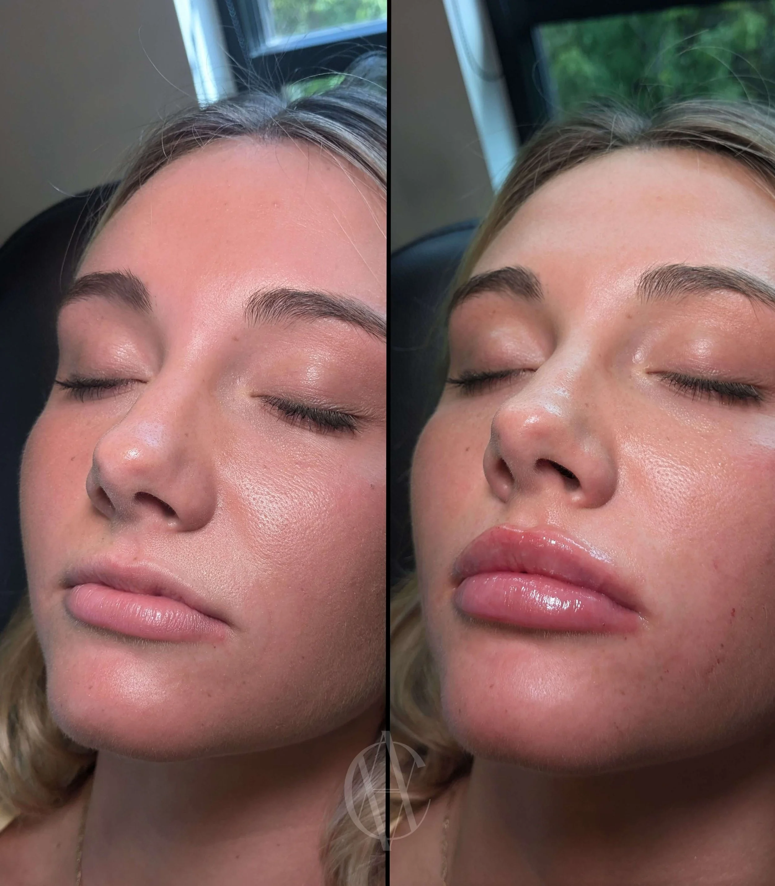 Lip Filler side by side before and after comparison showing improved symmetry and shape after one syringe of lip filler