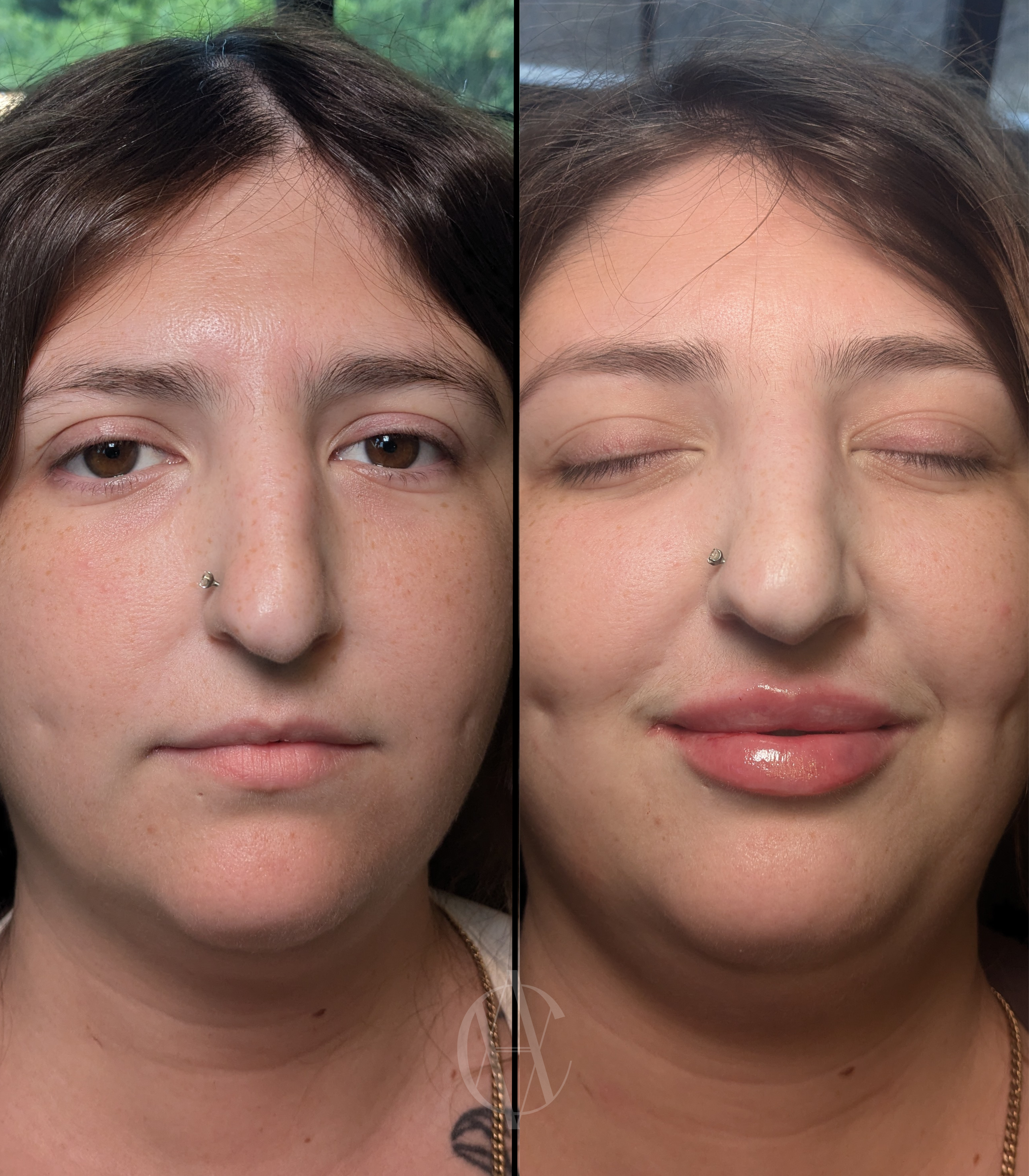 lip-filler-before-and-after-injected-at-a-class-aesthetics-med-spa-in-wisconsin.PNG