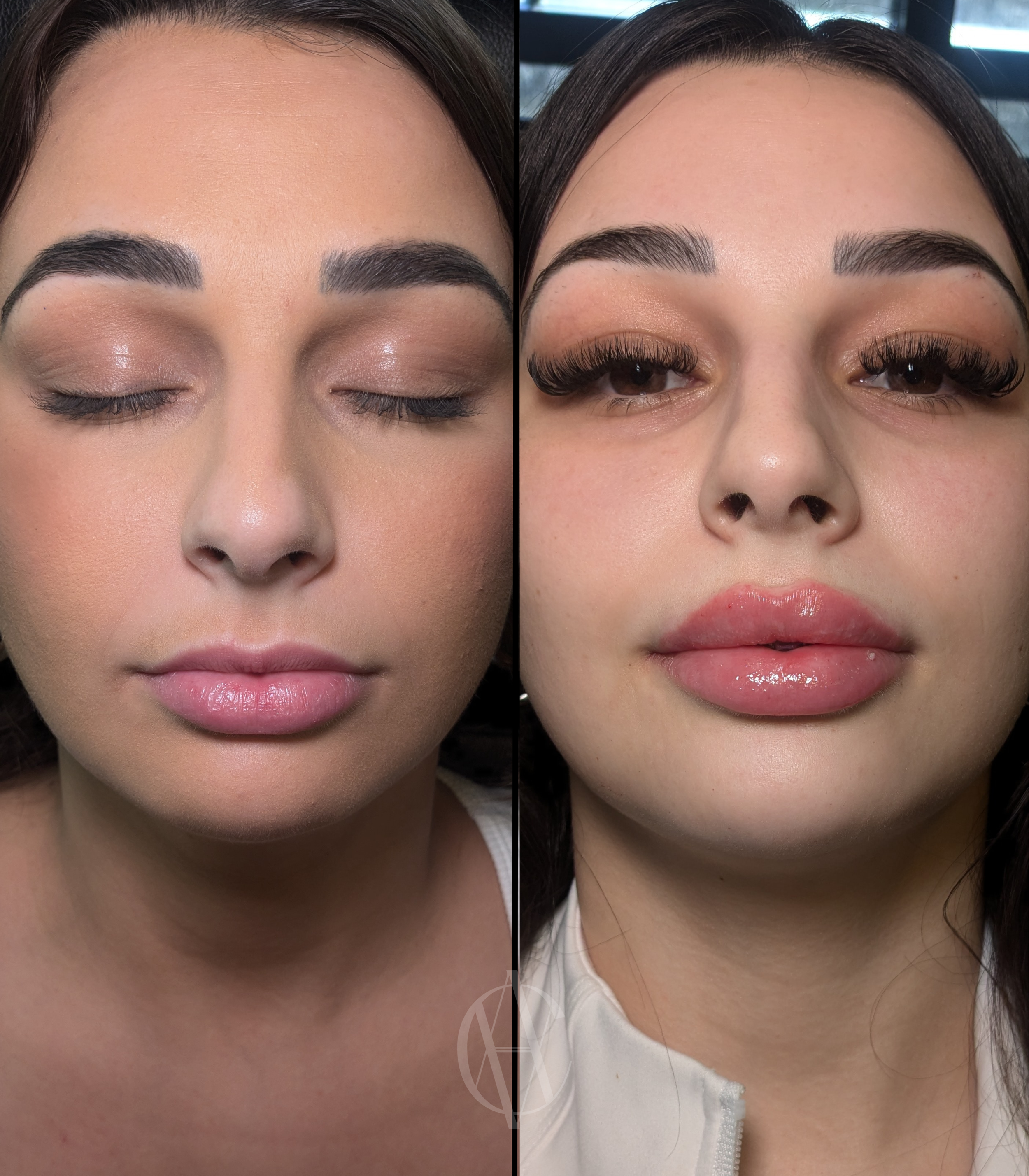 lip-filler-before-and-after-key-hole-injected-at-a-class-aesthetics-med-spa.PNG