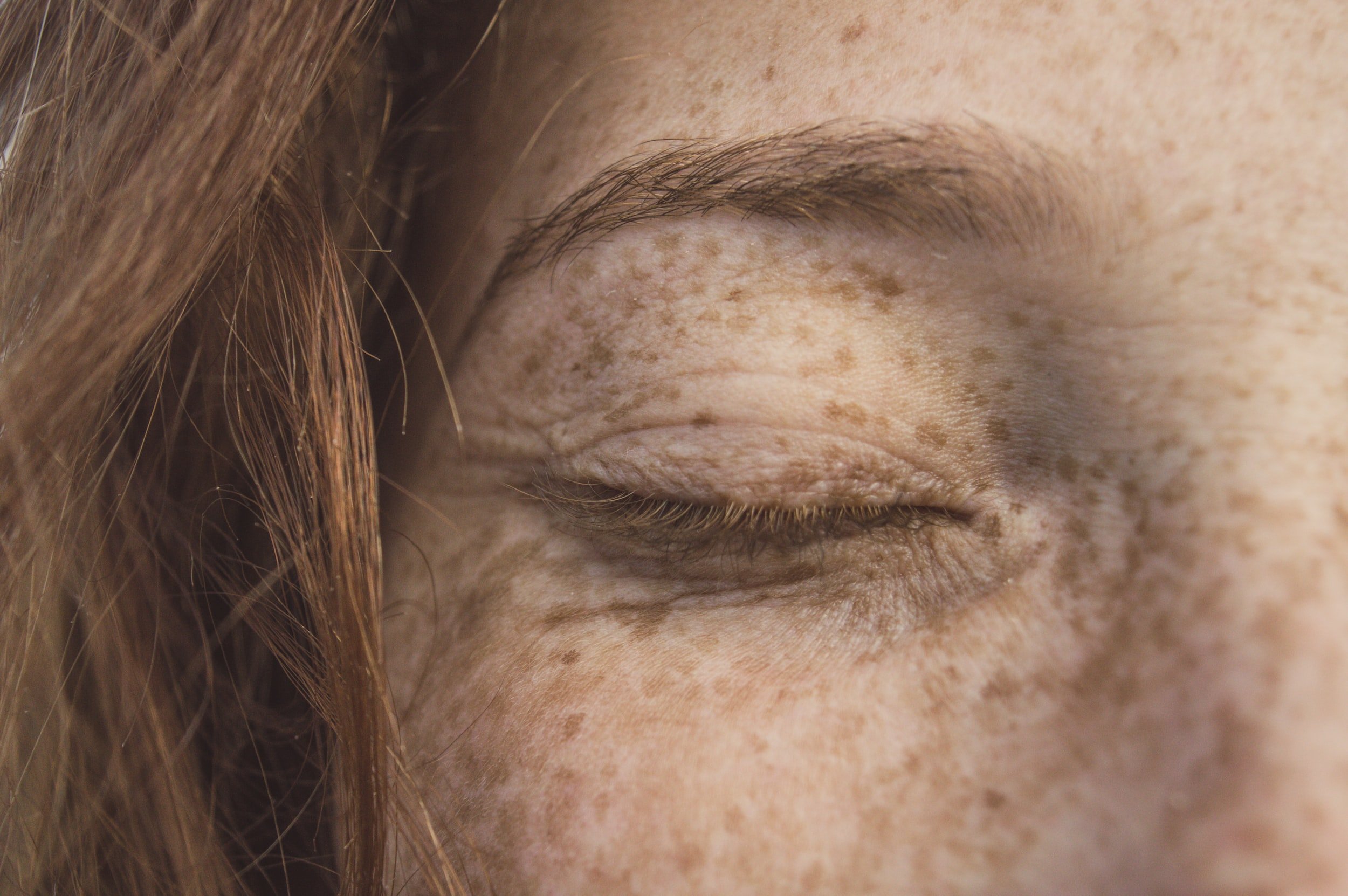 Radiesse: The Fountain of Youth