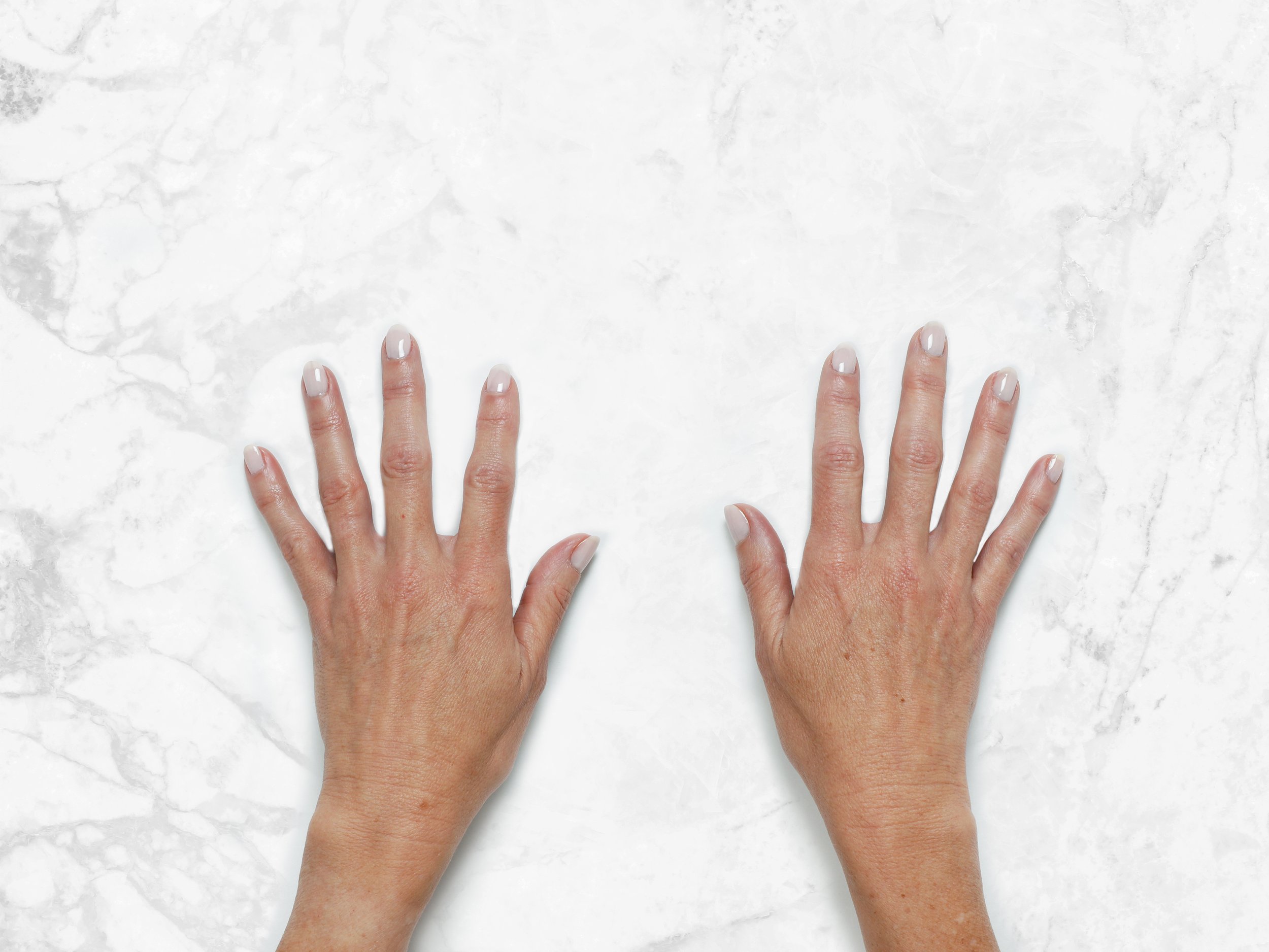 Hand Rejuvenation (don’t let your hands give away your age!)