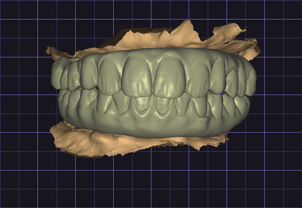 3D dental scan showing upper and lower teeth with surrounding gum tissue on a purple grid background