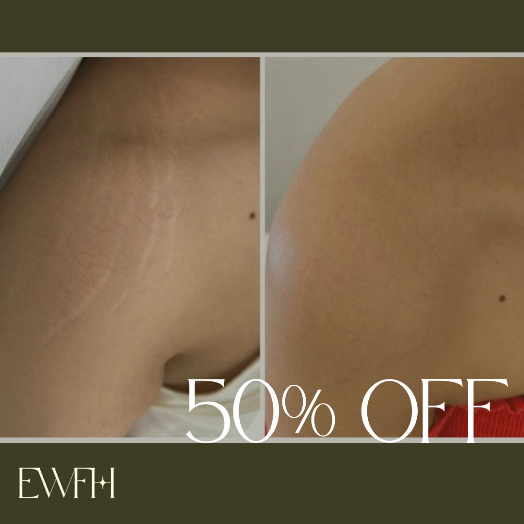 We all have stretch marks in hidden places, but they can now be camouflaged! ​​​​​​​​​@renewartistry are offering SMP &amp; stretch mark camouflage tattoo at 50% off 

#earthwindfirehair