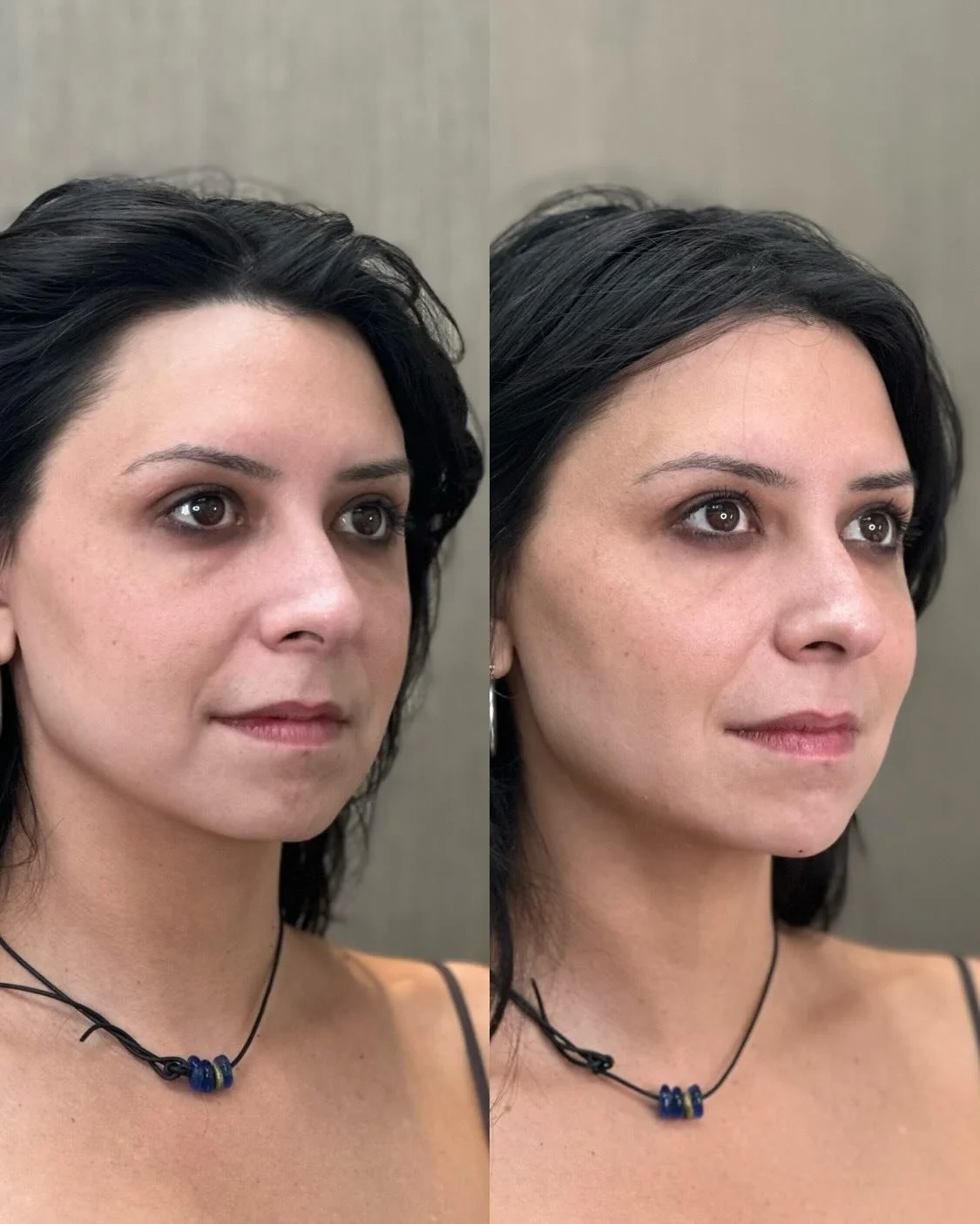 ✨Chin Filler ✨⁣
 This is our lovely patient before and immediately after filler. Featuring subtle enhancements to the chin and cheeks for ultimate facial balancing 💉

Swipe ➡️ to see how expertly placed filler can refine the jawline, balance the low