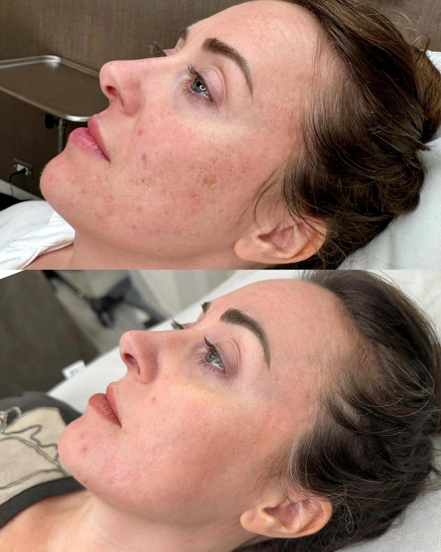 ✨Skin Transformation 1.5 Years in the Making✨

Swipe to see these incredible before &amp; after results from our beautiful patient who struggled with deep acne scars since her teen years. 💫

Through a customized treatment plan including:
💉 2 sessio