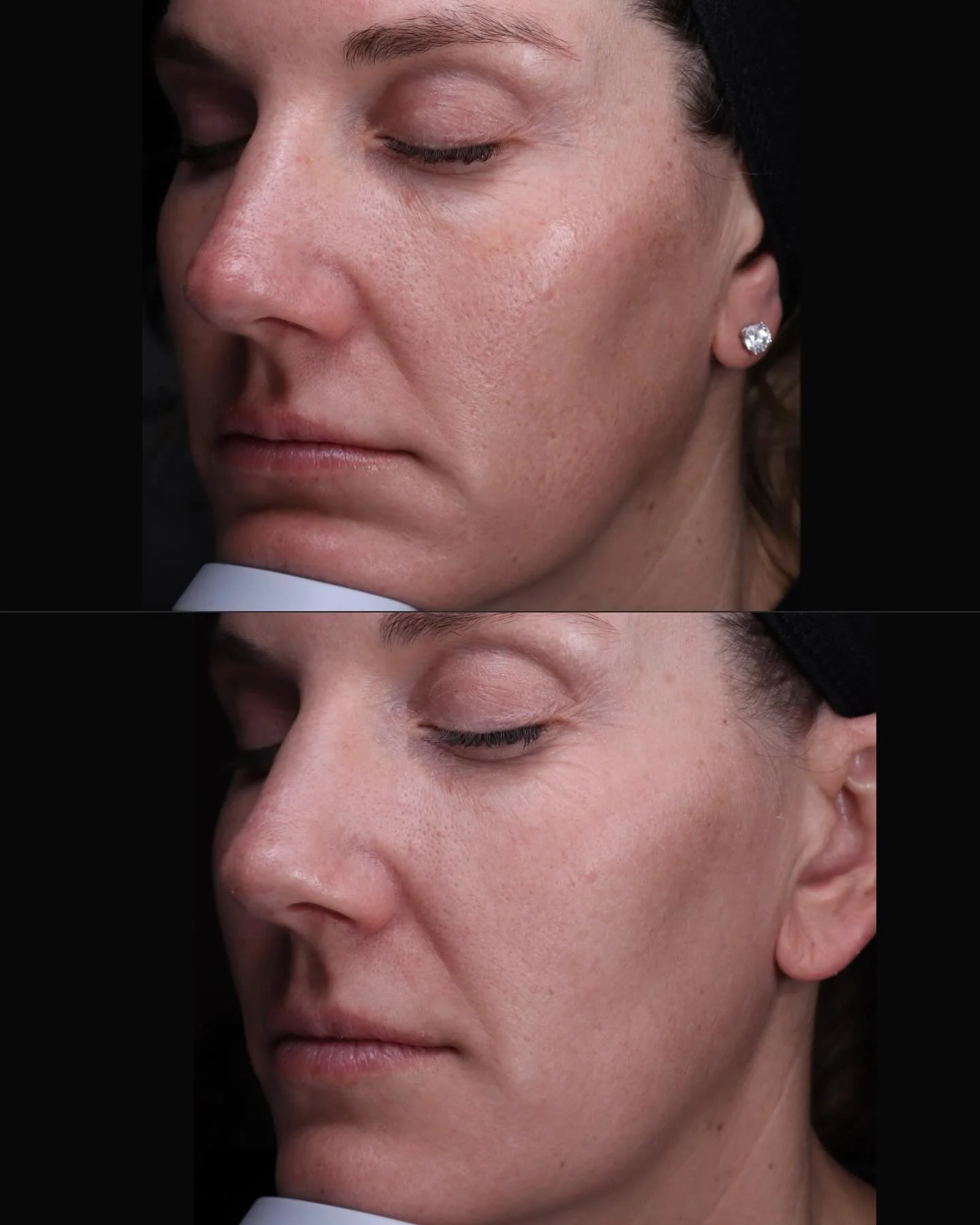 ✨ HALO Laser Glow-Up: One Session Results! ✨ Swipe ➡️ to see her TruAge Skin Score 🤩

📊 VISIA Skin Analysis shows it all: &bull; Actual Age: 42 &bull; TruAge Score BEFORE: 42-45 &bull; TruAge Score AFTER HALO: 35 🤯

These are real, device-measured
