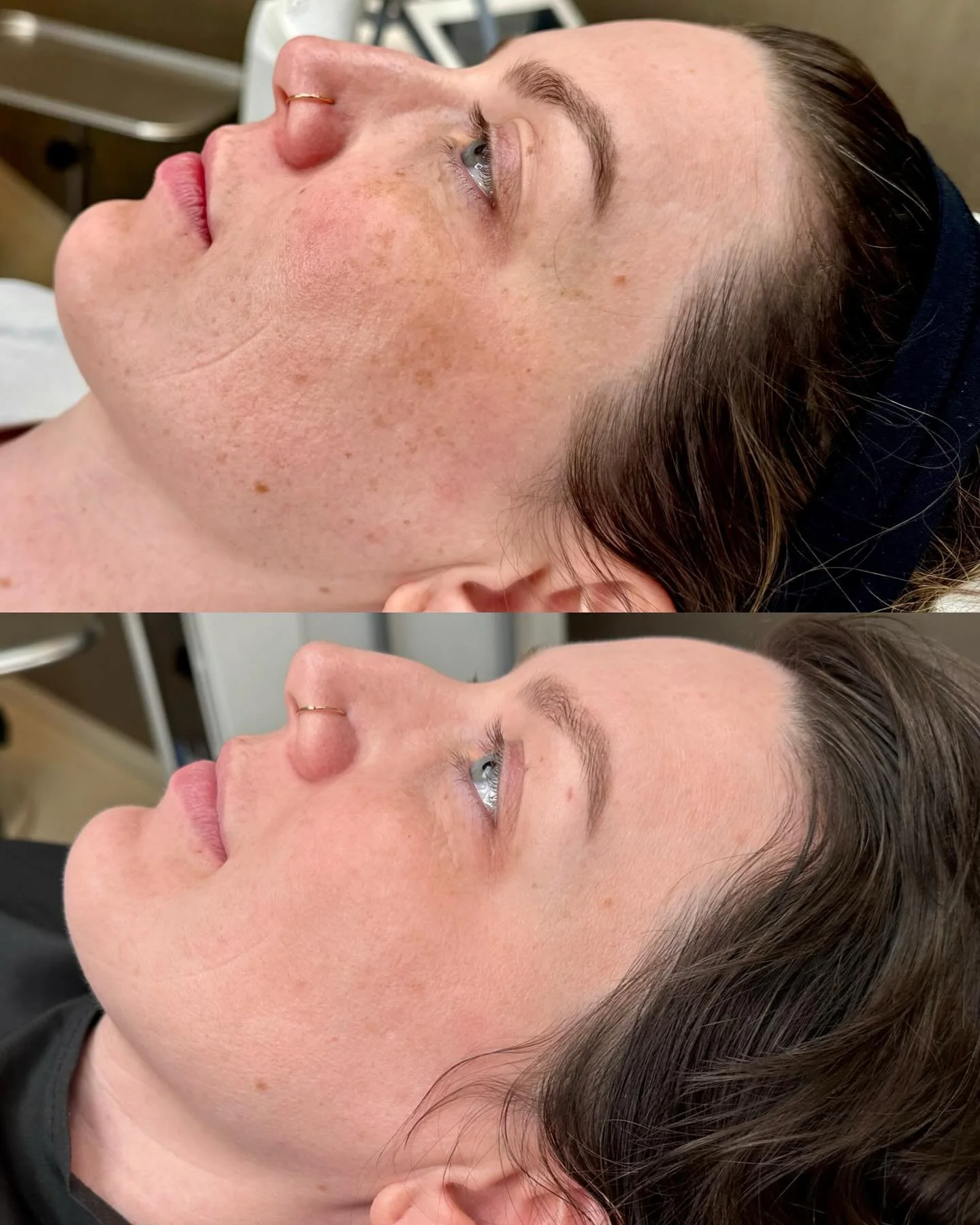 ✨ After 3 sessions of BBL + MOXI ✨

✨ Less sun damage ✨ Fewer brown spots ✨ Smoother texture ✨ Brighter, more even tone ✨ Most importantly &mdash; healthier skin

What we love most is that this skin isn&rsquo;t just prettier &mdash; it&rsquo;s health