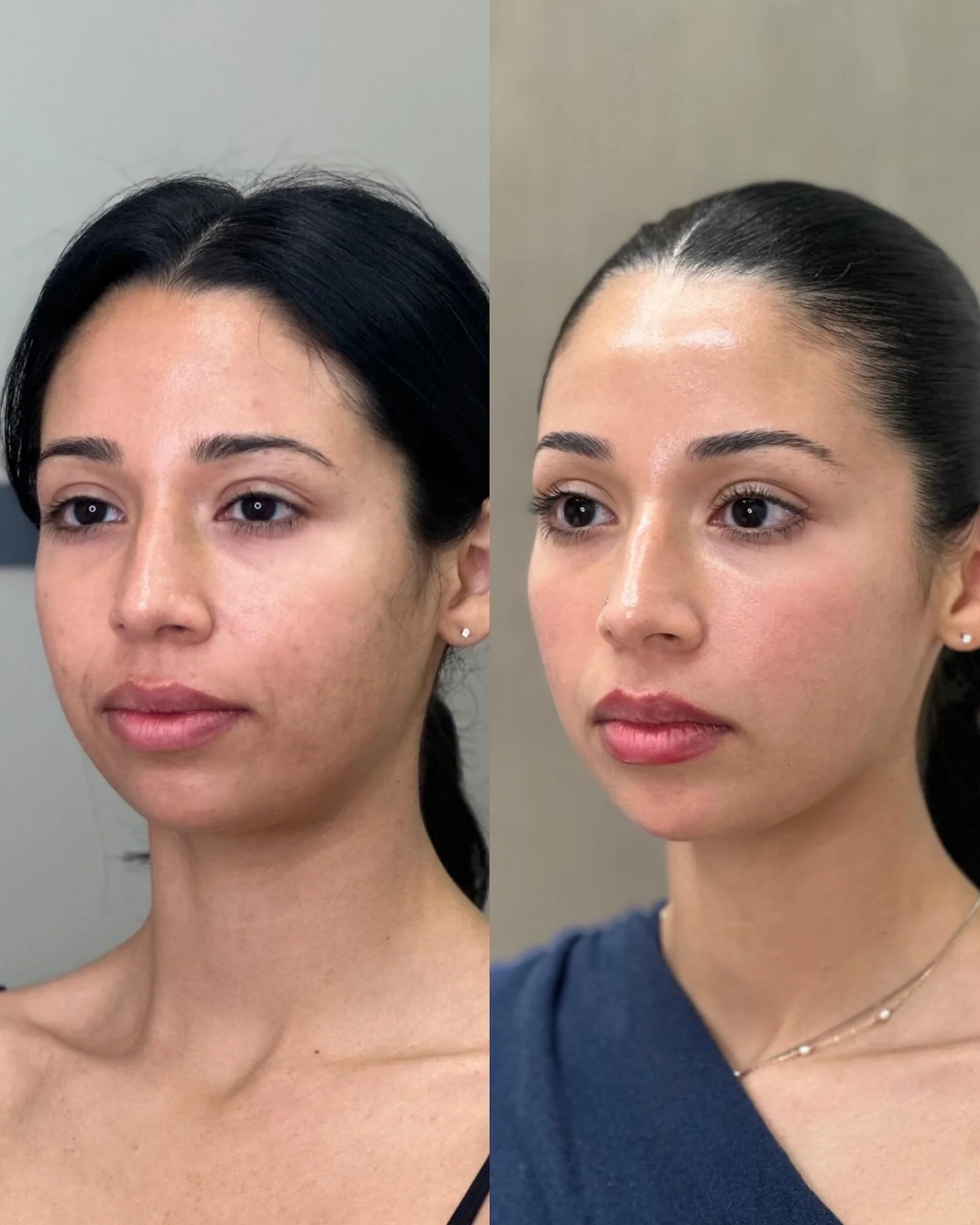 ✨ Real skin. Real results. ZERO skin makeup. ✨

This is what happens when you stop chasing one-off treatments and commit to a comprehensive, holistic plan 👏
Our patient&rsquo;s glow-up is the result of a customized treatment plan that works with the