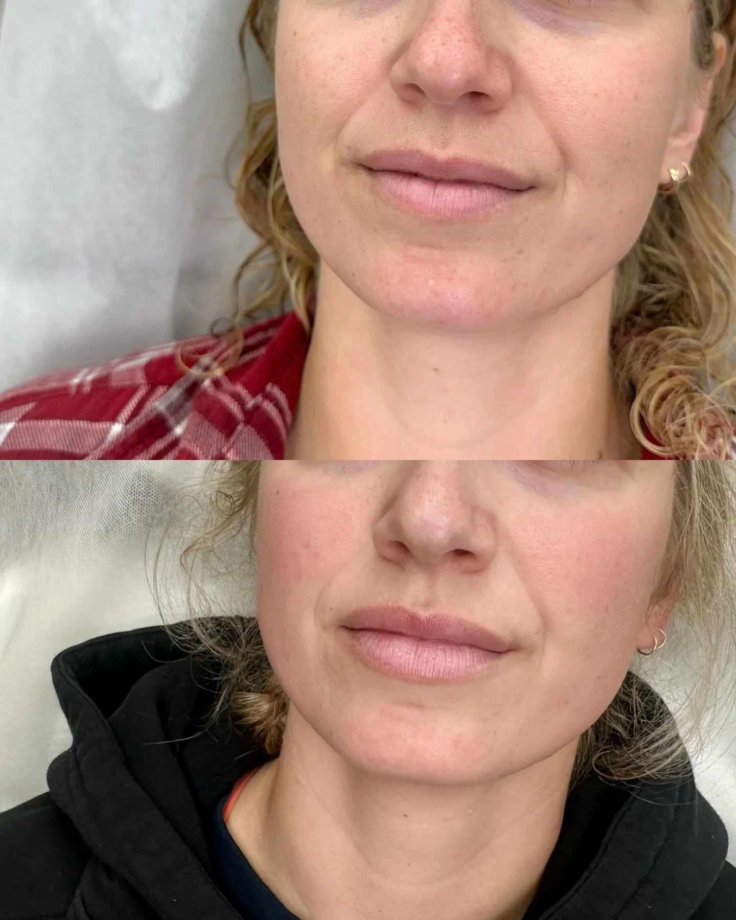 Invest in your future lips. 🕊️✨

When it comes to your lips, the best work is the work nobody notices, yet it is impactful 😉 Swipe to see a subtle balancing with our signature Lip Glaze&mdash;captured 4 weeks post-treatment.

For our younger patien