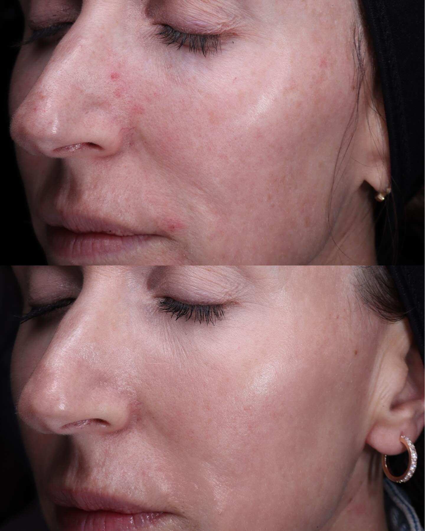 The HALO laser glow is real, but the skin health benefits are even better. 🕊️

Beyond the visible reduction in pigmentation and the smoothing of skin texture, this patient&rsquo;s skin is now functioning more efficiently.

The MUDITĀ Difference: 
Wh