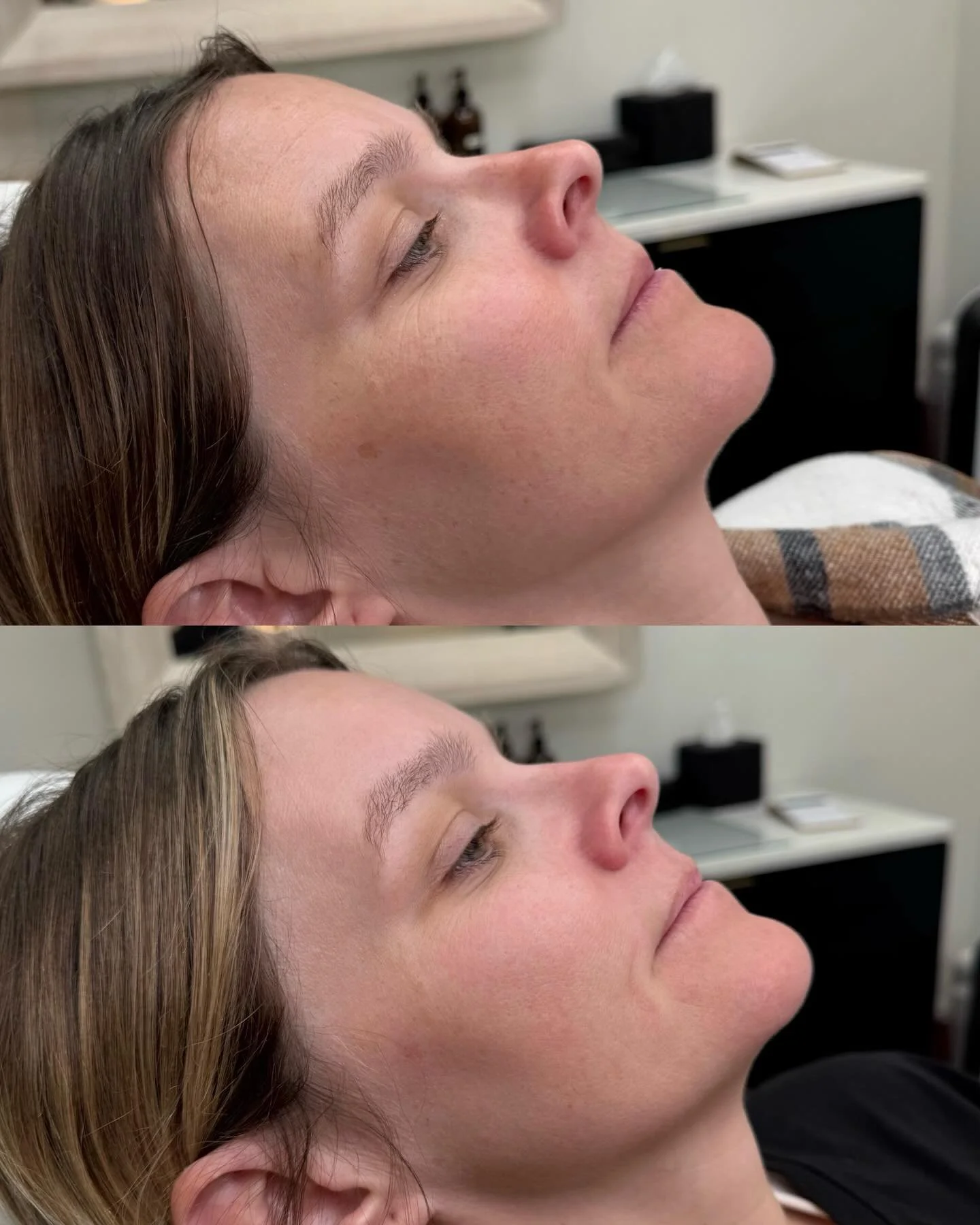 The Glow Up is Real ✨

Check out these beautiful results after just two sessions of our favorite powerhouse duo: BBL (BroadBand Light) + MOXI Laser. While the &ldquo;before and after&rdquo; speaks for itself, the real magic is happening beneath the s