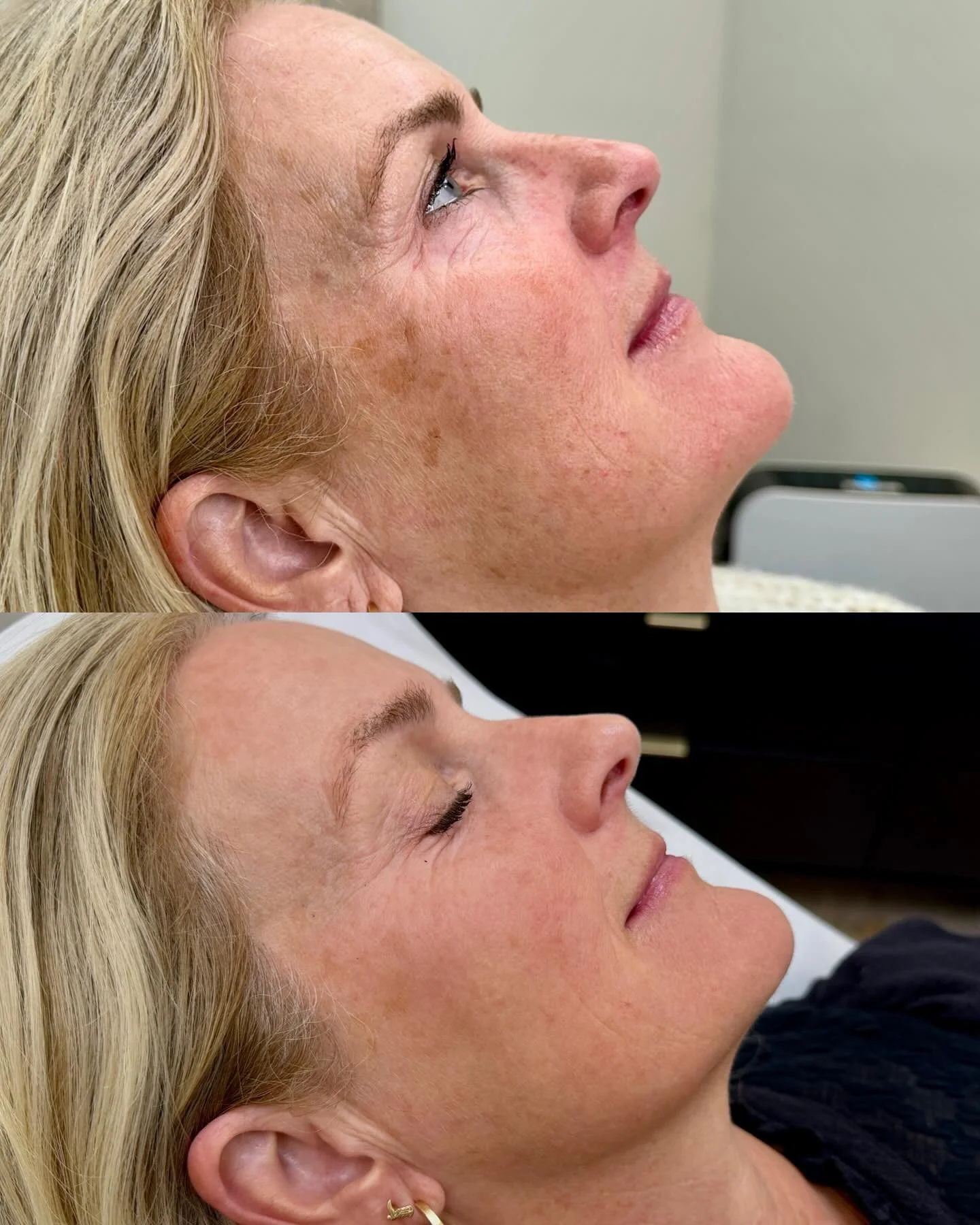 ✨ Proof that consistency is the ultimate glow-up. ✨

Skin transformation after two sessions of BBL (BroadBand Light).

This patient came to us with years of cumulative sun damage and brown dyschromia. By targeting the pigment at a molecular level, we