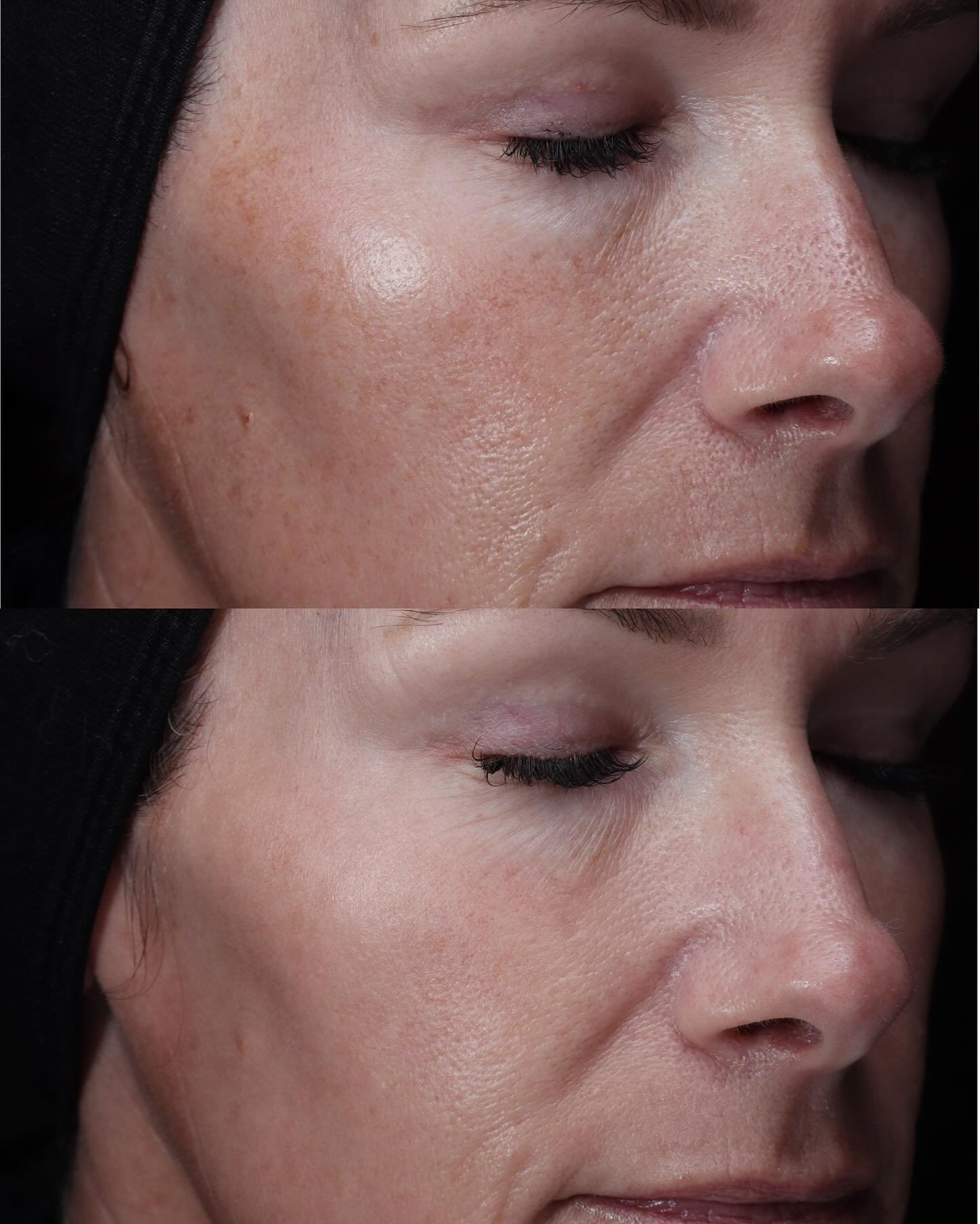 ONE session skin glow-up✨

We call the BBL + MOXI combination our &ldquo;power couple&rdquo; for a reason. While the immediate results are undeniable, the real magic happens beneath the surface. At MUDITĀ, we aren&rsquo;t just chasing a temporary glo