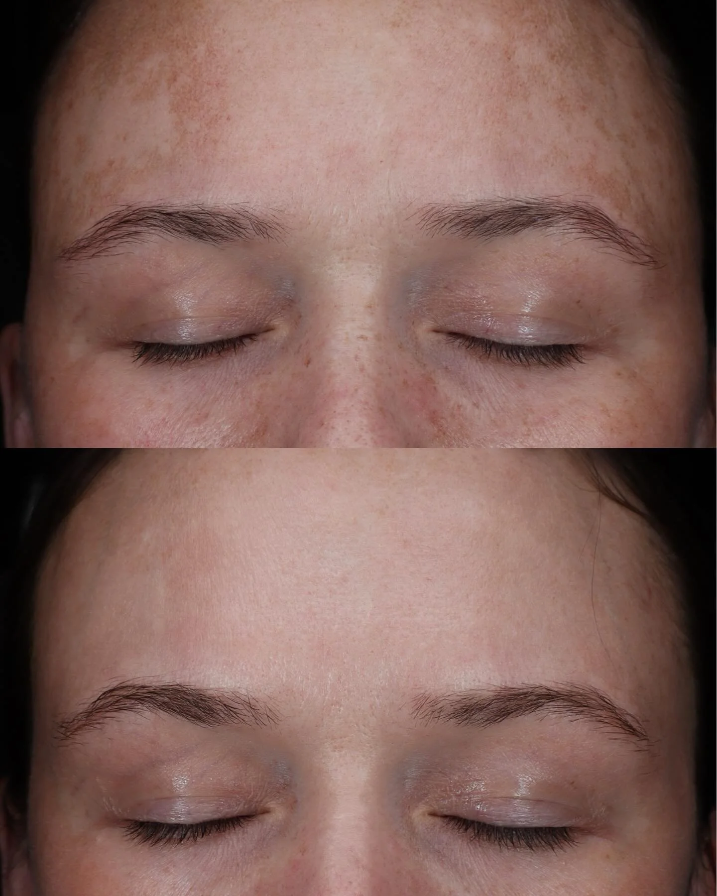 Less makeup, more MOXI✨⚡️ Just 3 months of focusing on true skin health and the results speak for themselves. Swipe to see this transformation! ✨

Melasma is a stubborn, complex skin condition characterized by patches of discoloration and hyperpigmen