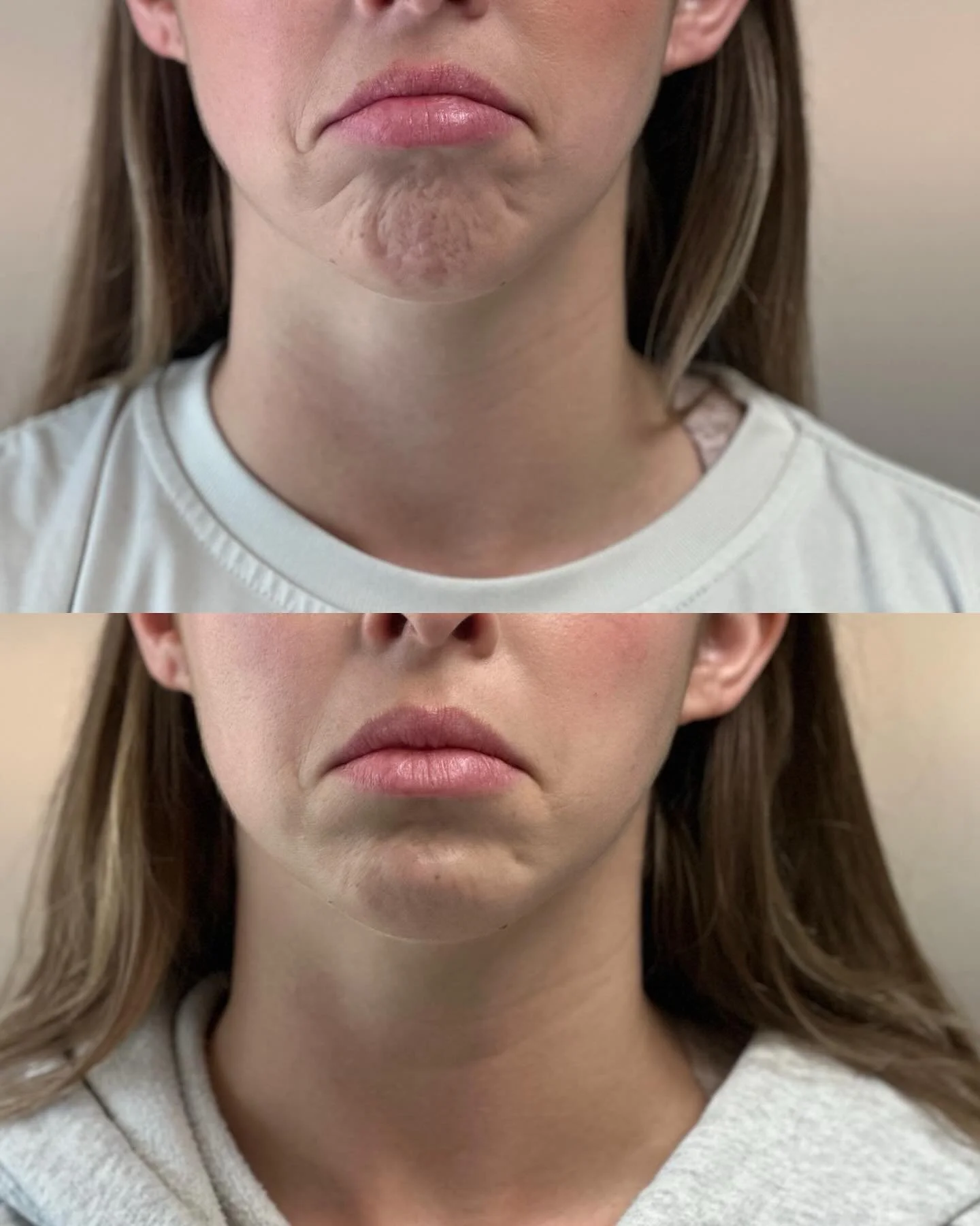 Why do we inject Botox in the chin? This is the reason&hellip;. Swipe ➡️

Did you know Botox in the chin can actually change your profile? 🤯

A lot of us hold subconscious muscle tension in our chins. Over time, this overactive muscle (the mentalis)