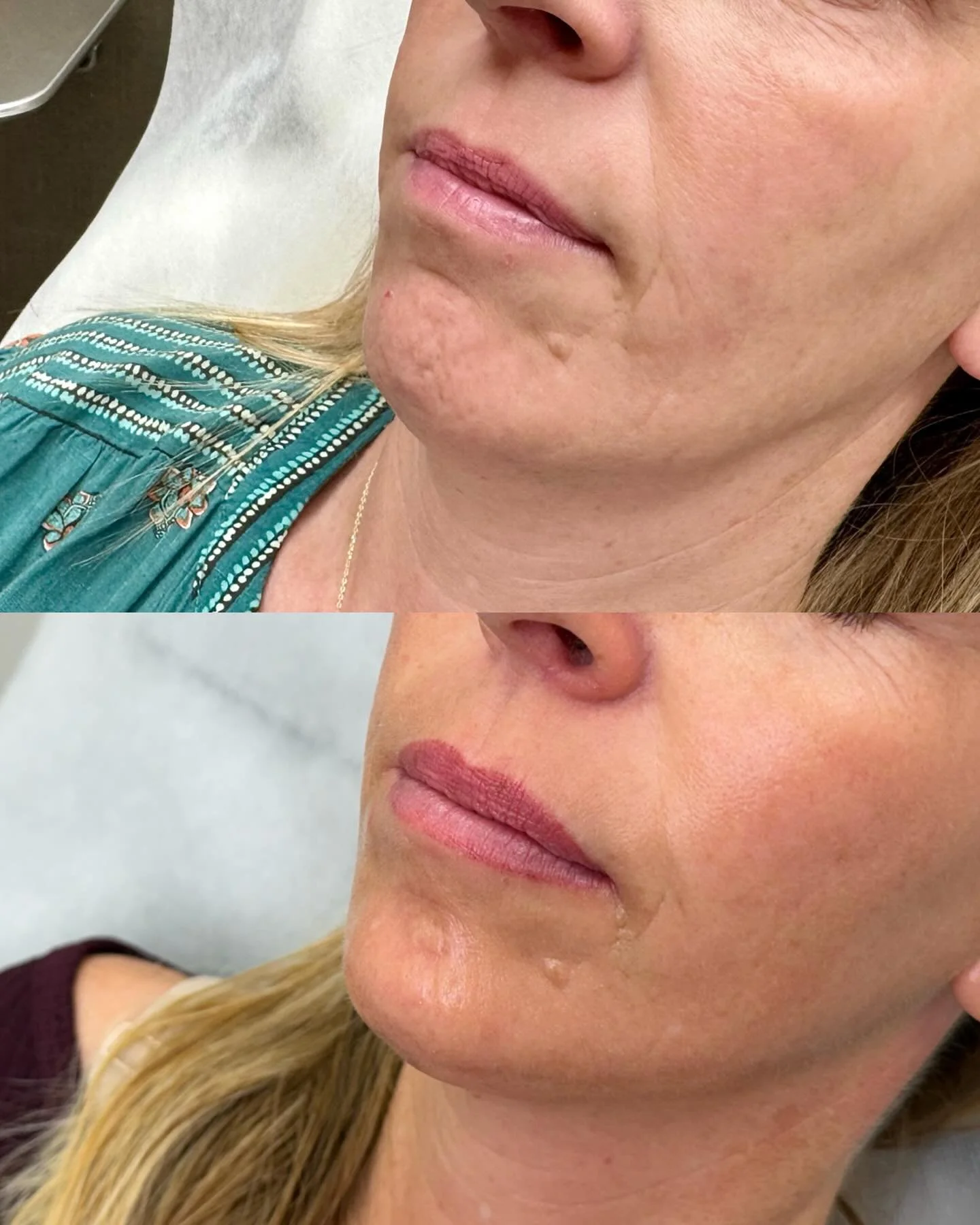 ✨Over 2 YEARS with 1 customized plan ✨

Swipe to see what happens when you commit to the long-term journey of skin health! ➡️ From 2024 to 2026, we worked closely with this beautiful patient to design a comprehensive, multi-modality treatment plan ta