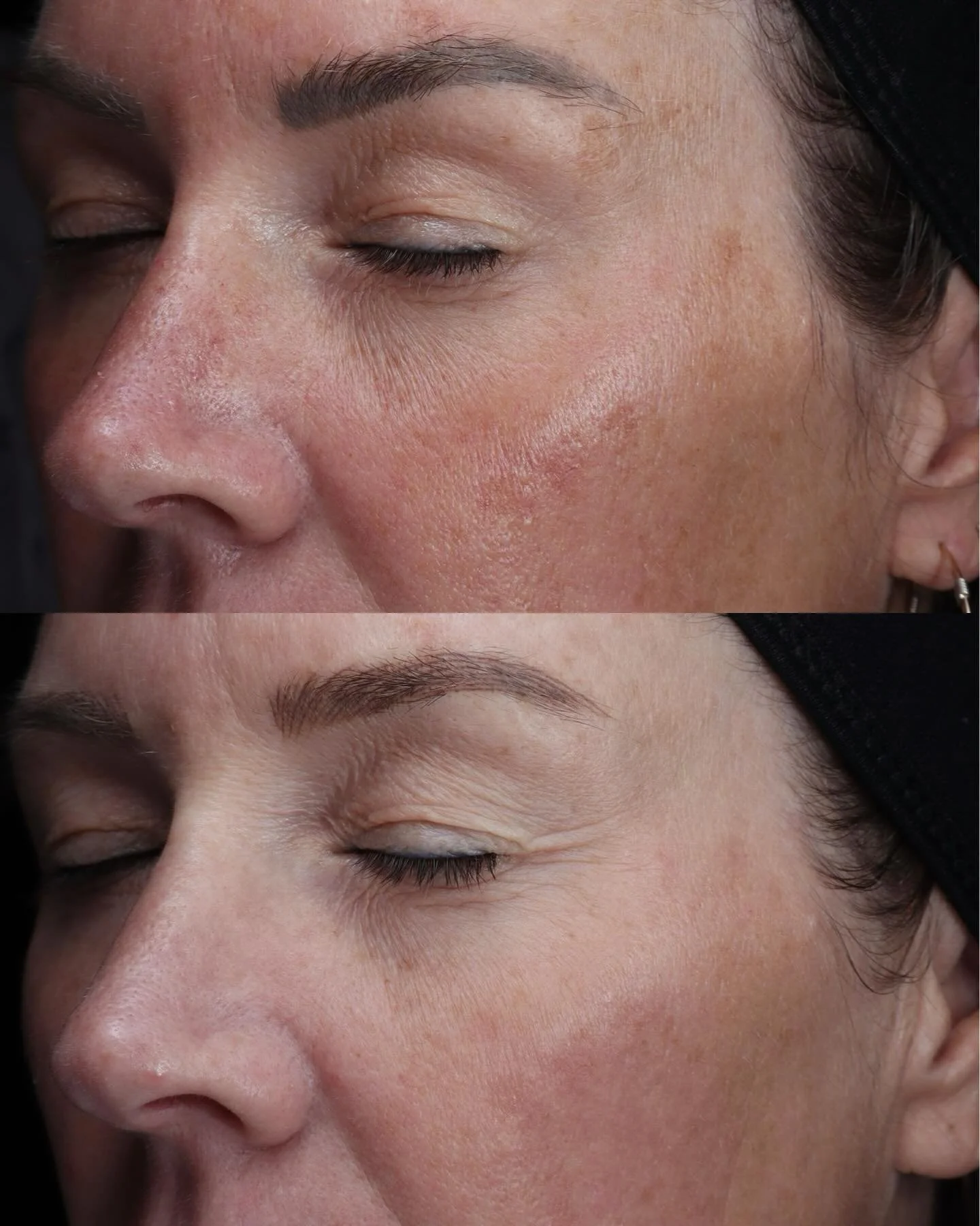 Skin health is an inside job&mdash;and the VISIA camera doesn&rsquo;t lie. 🔮✨ Swipe to see this 2-session glow up.

When you look at these impressive results, it&rsquo;s easy to focus on how smoother and more luminous her skin looks. But at MUDITĀ S