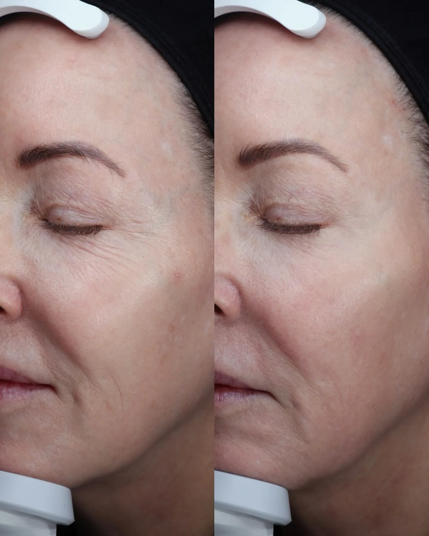 ✨She already had beautiful skin. We simply refined it✨
The best skin transformations aren&rsquo;t always dramatic. Sometimes, it&rsquo;s the subtle softening of fine lines, a smoother texture, and that healthy, luminous glow that makes all the differ