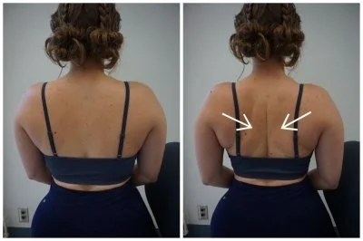 Sit or stand with good posture. Squeeze your shoulder blades back and down. If there is pain, stop the exercise. Complete 10 repetitions, 3 sets. Repeat 2x/day. Take breaks as needed