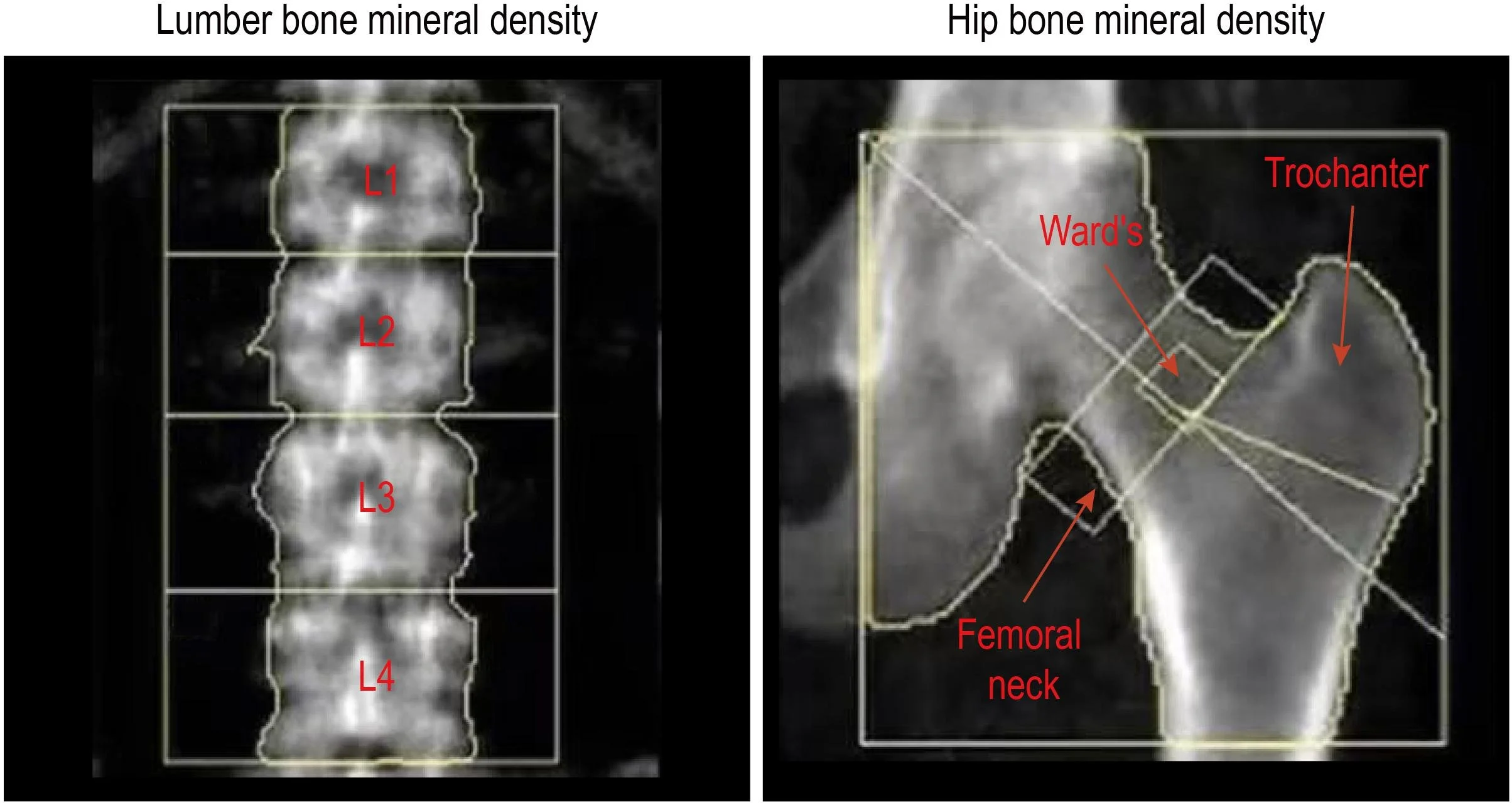 What Your Spine May Be Telling Us About Bone Health — and Brain Health