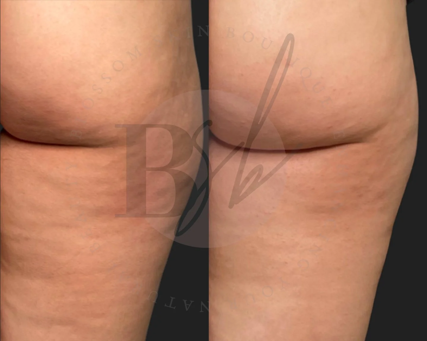 Cellulite treatment