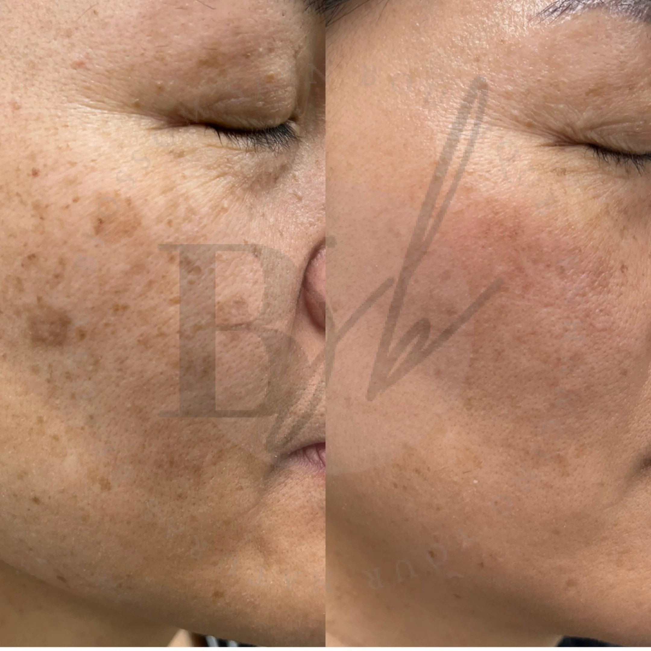 Melasma Treatment