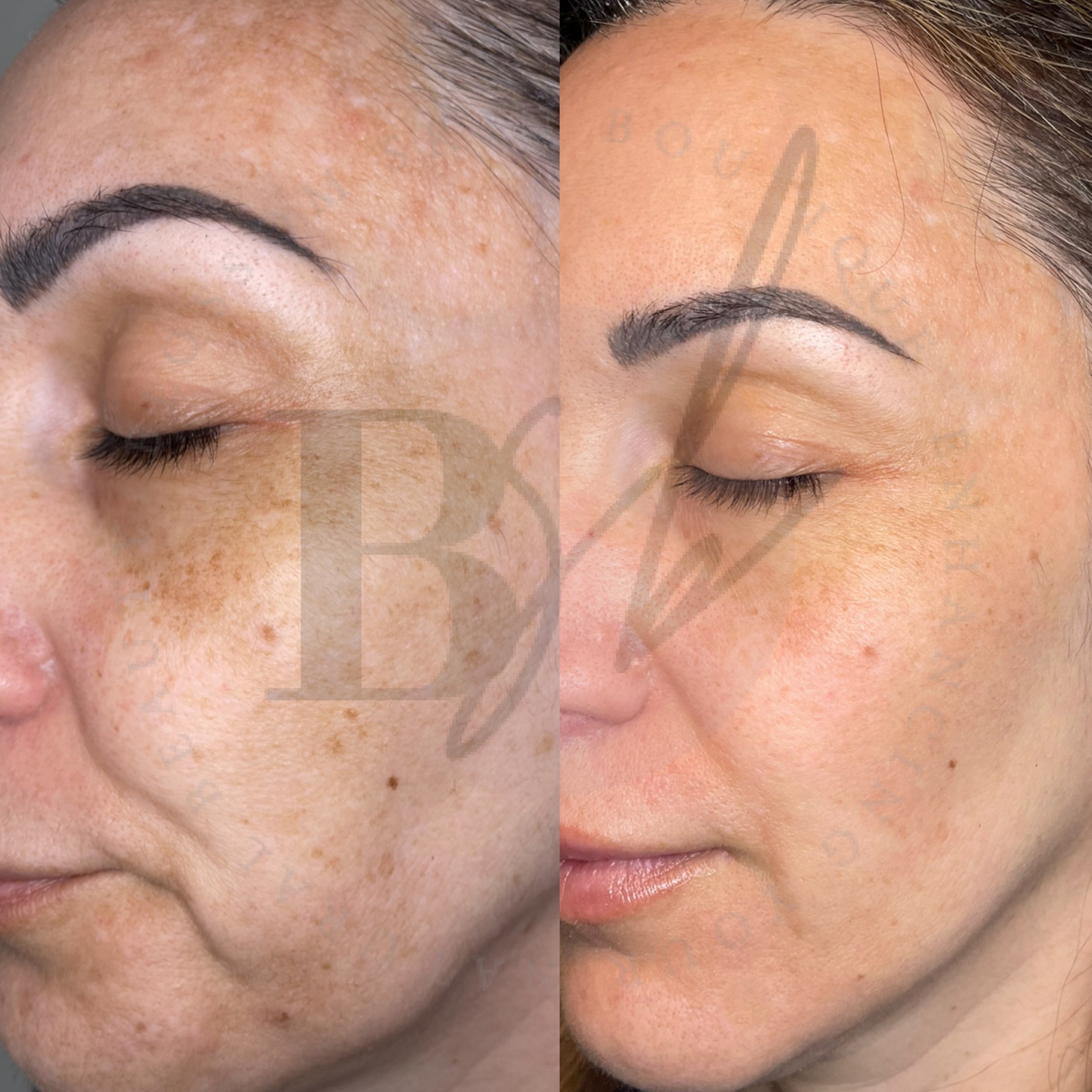 Pigmentation Treatment