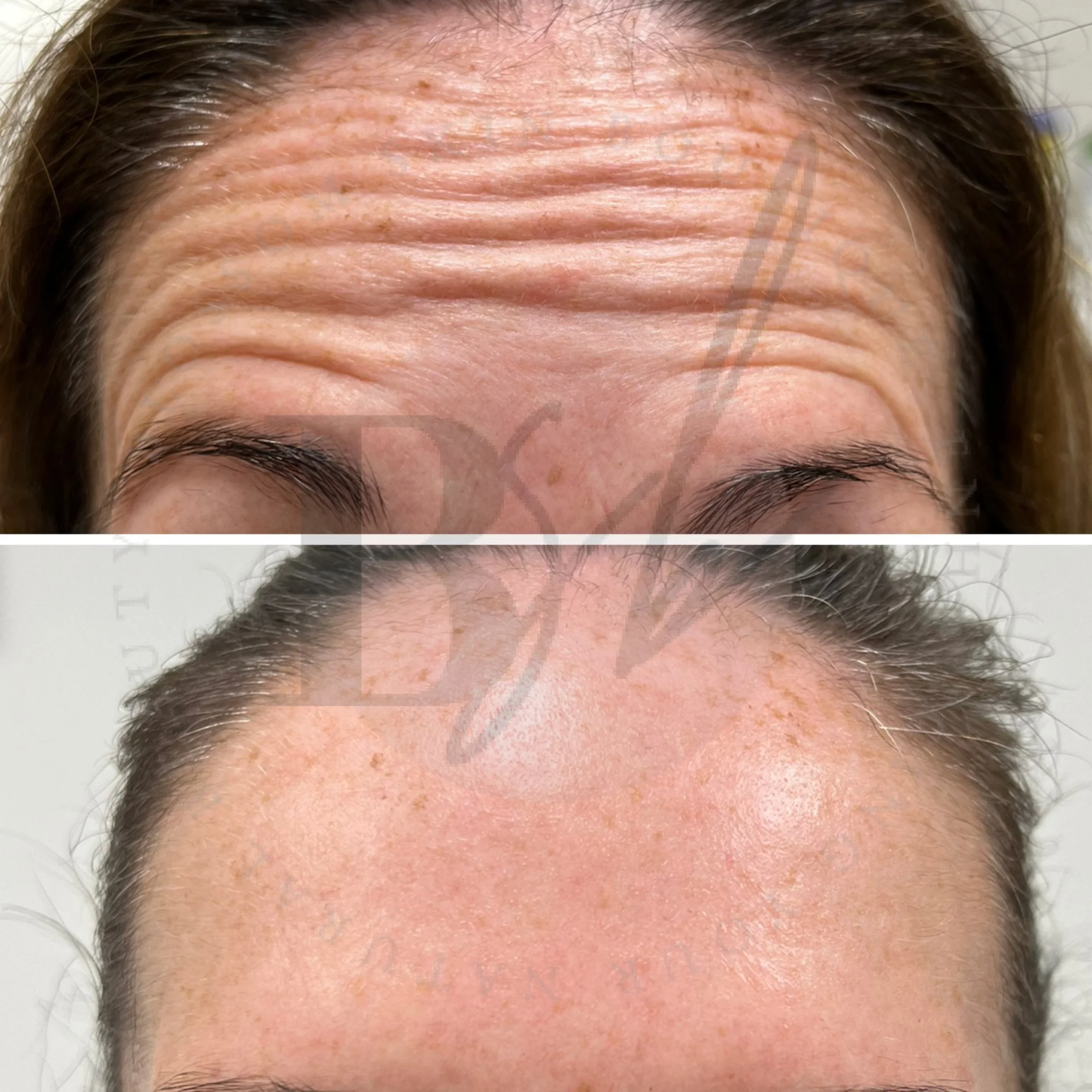Botox/ Dysport Mississauga