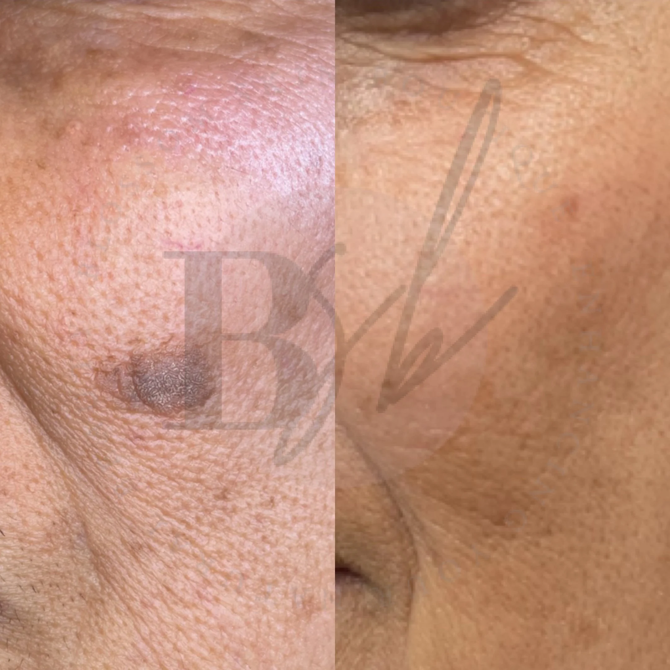 Keratosis Removal