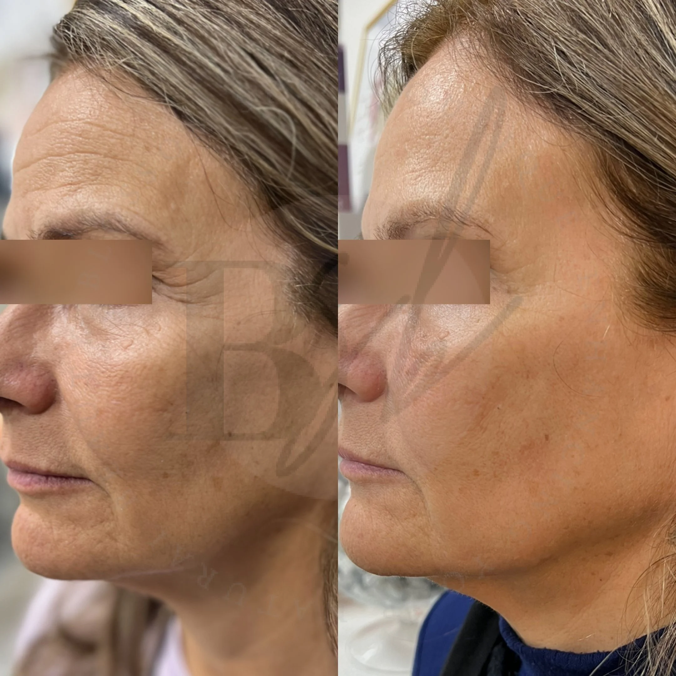 Facial Rejuvenation