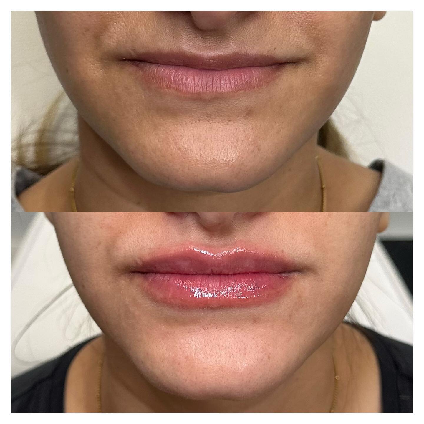 💉Treatment: LIP FILLER 
🧐Purpose: Add volume &amp; a more hydrated look
💰Cost: $650+
🧬Product: Hyluronic Acid 
⏰Appointment time: 60-90 mins
🥰Comfort: topical numbing or mucosal block ($25 charge for mucosal block)
🤕Downtime: bruising and swell