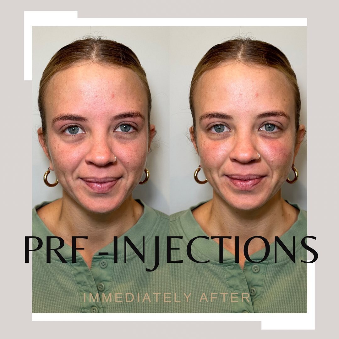 𝙋𝙍𝙁 𝙄𝙉𝙅𝙀𝘾𝙏𝙄𝙊𝙉𝙎 for the under-eye, this is her before and immediately after. This will go down and produce collagen overtime. We will probably need to do three treatments. 

Your solution to a refreshed and youthful under-eye area! 

PRF 