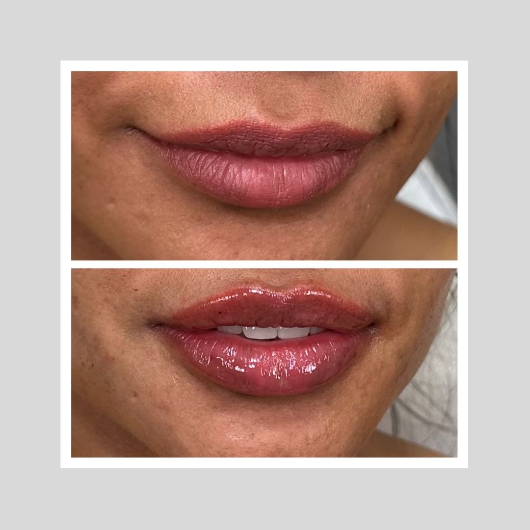Lip Filler